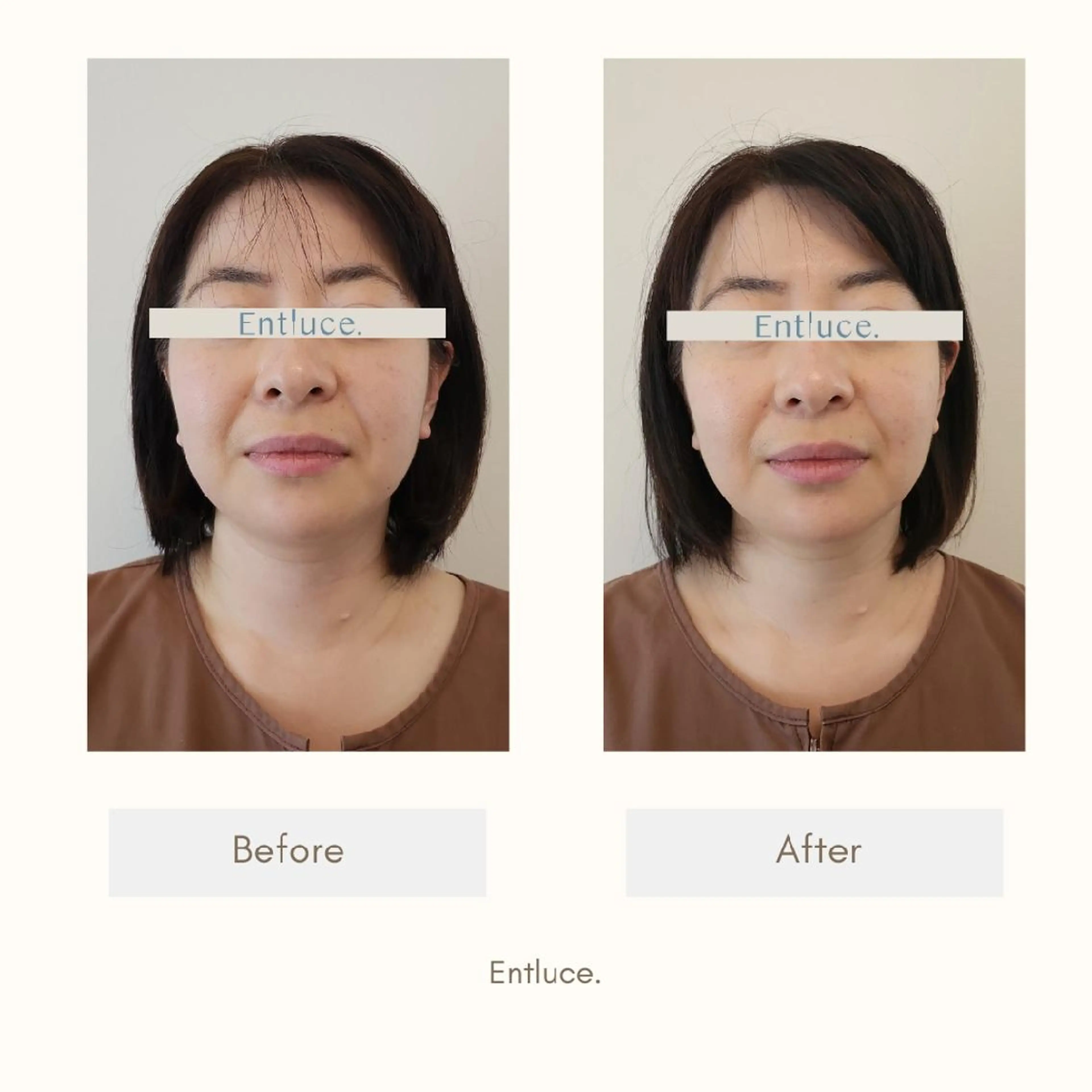 即効⚡小顔美容鍼🪡 むくみたるみ脂肪解消のエステ・リラクイメージ