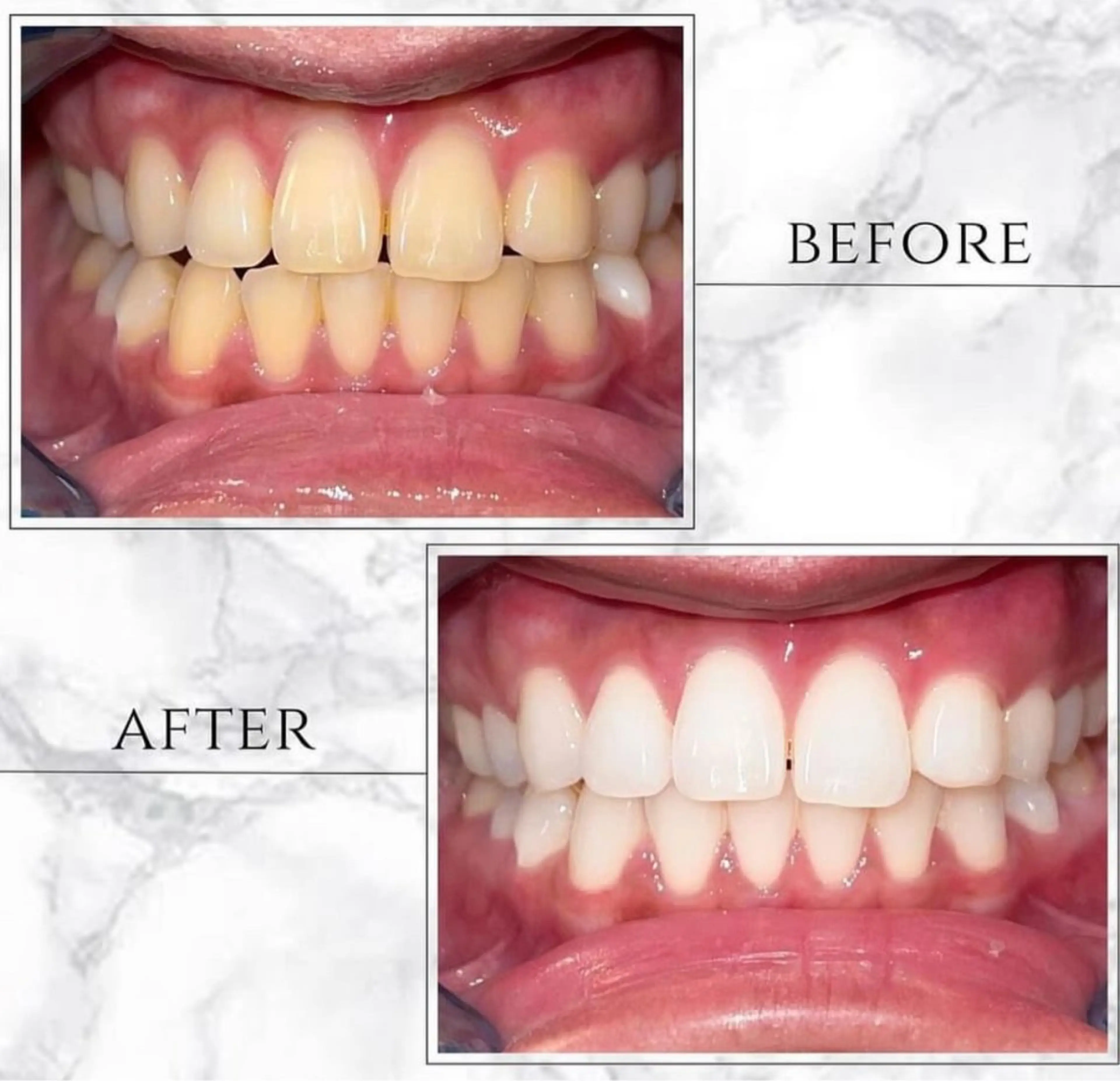 【ダントツの仕上がり】プレミアムホワイトニング30分照射×最高峰3色LEDライト効果抜群の写真