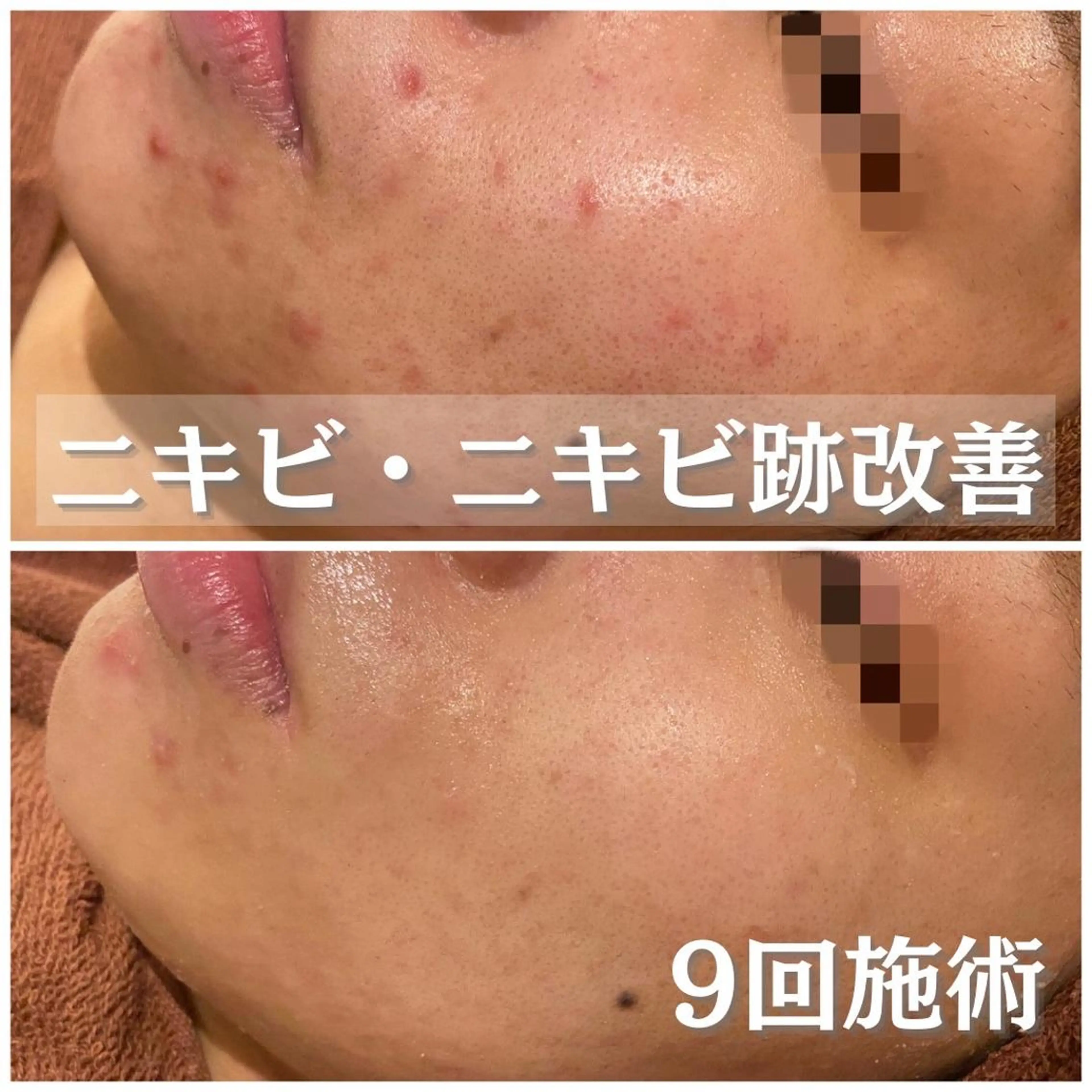 ショート カラー パーマ ヘアアレンジ メンズ キッズ ネイル マツエク・マツパ アイブロウ エステ リラク 夏までに肌荒れ卒業 するサロン🌻のエステ・リラクイメージ