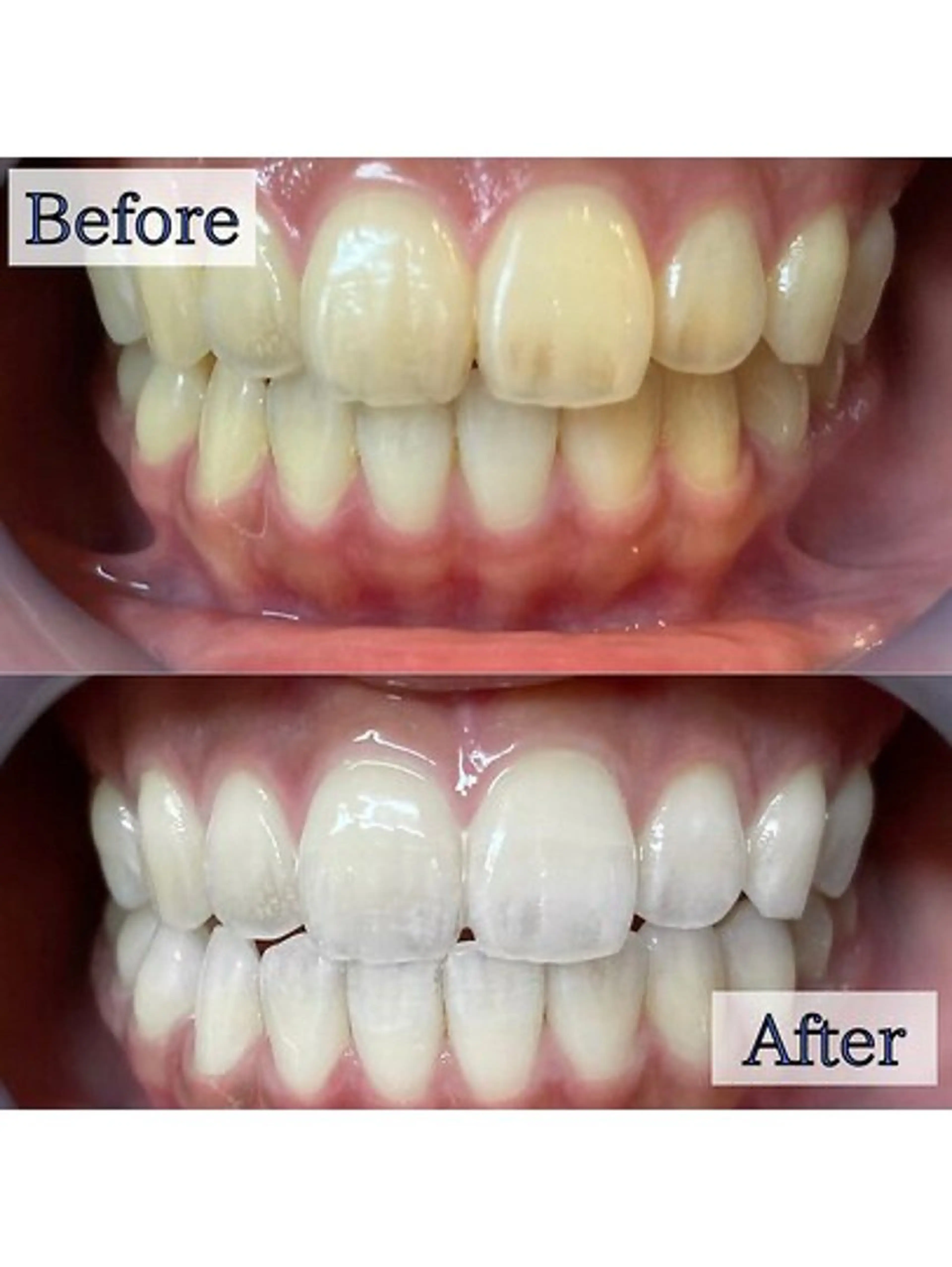 【👑人気No.1👑】 5分照射×2回🦷通常の約2倍の照射パワー🔥最新高速ハイパワーセルフホワイトニング🎶の写真