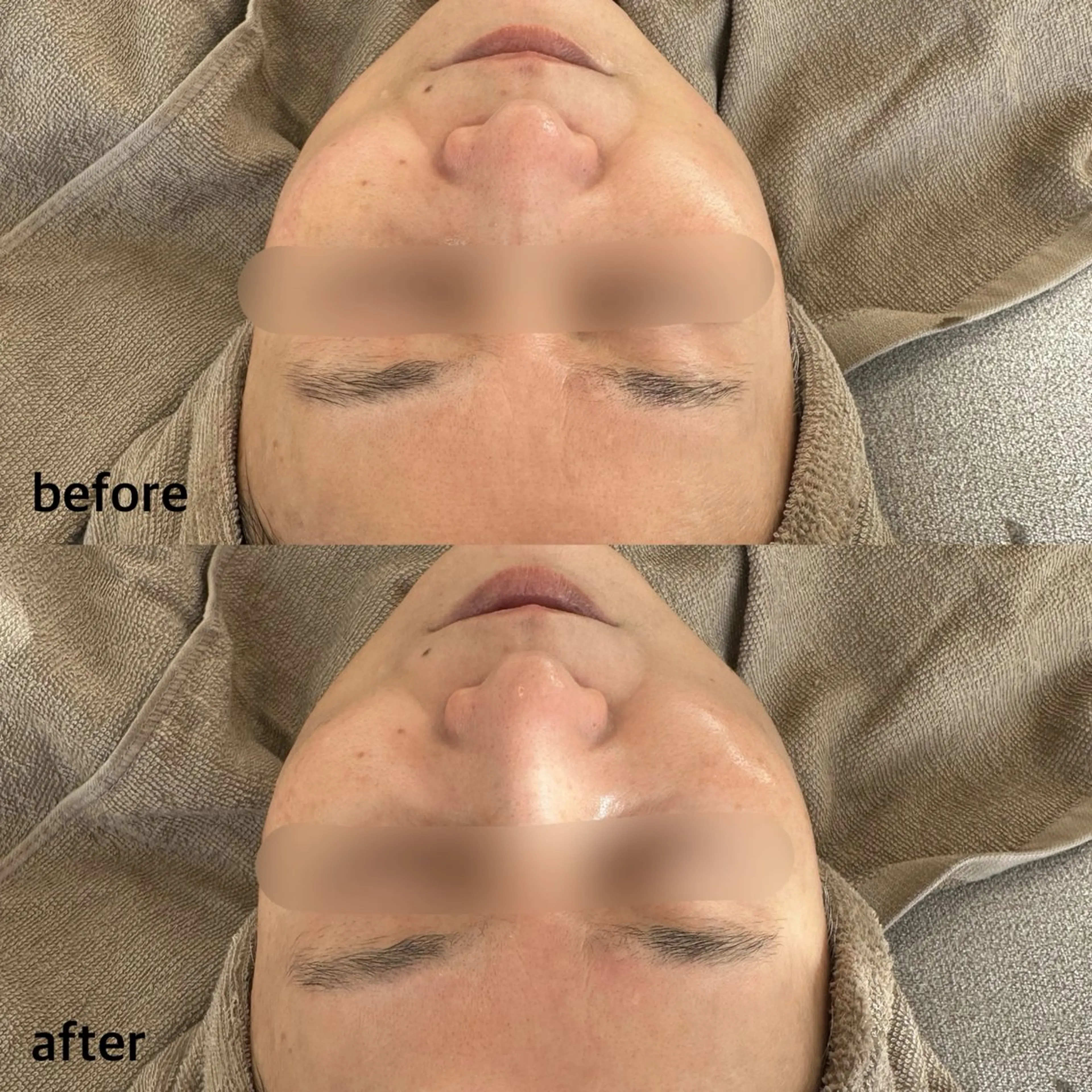 ハーバルフルーツピーリング ✩.*˚ ハリ、ツヤ激変!肌質改善の写真