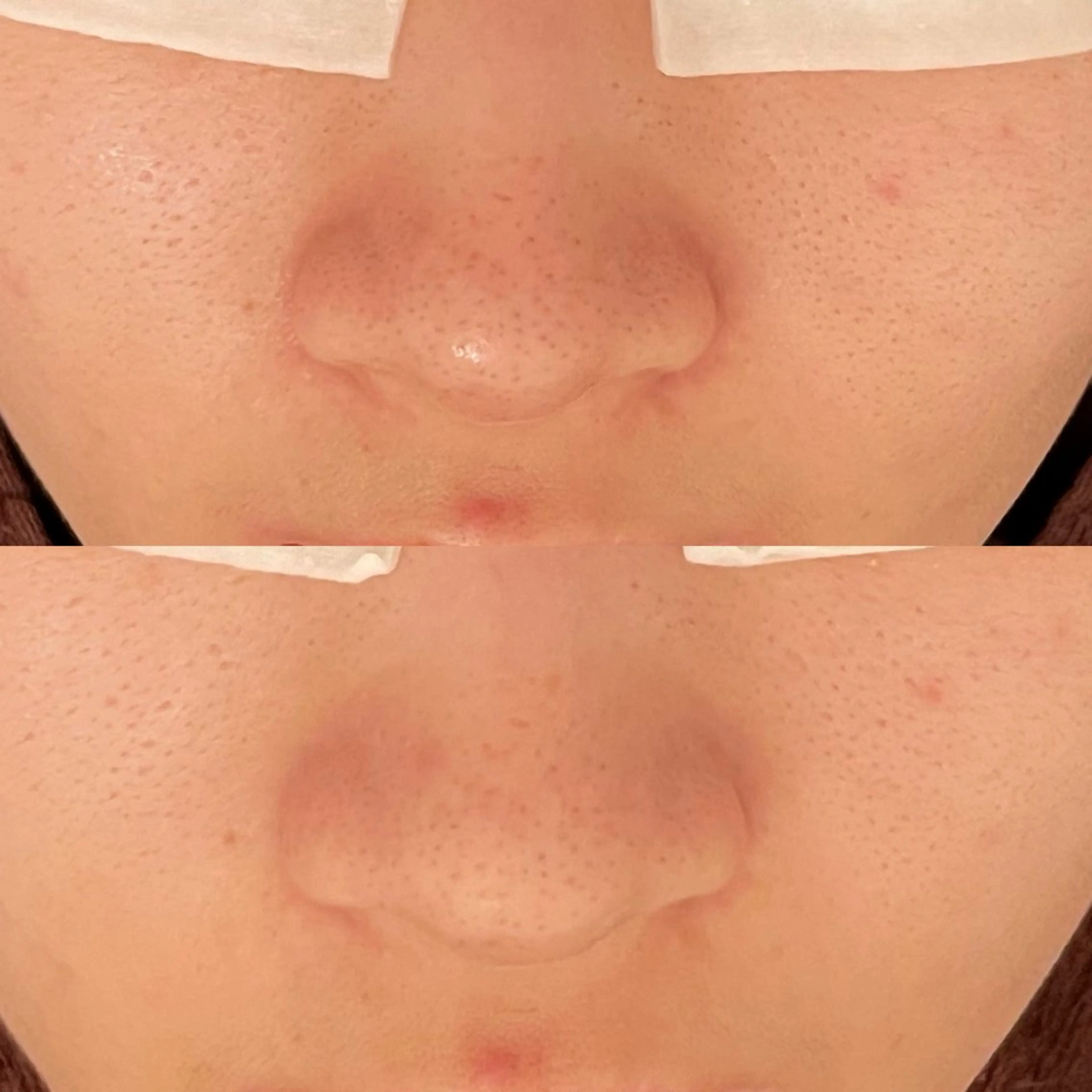 エステ 毛穴ケア/毛穴診断/ 毛穴洗浄〔心斎橋〕のエステ・リラクイメージ