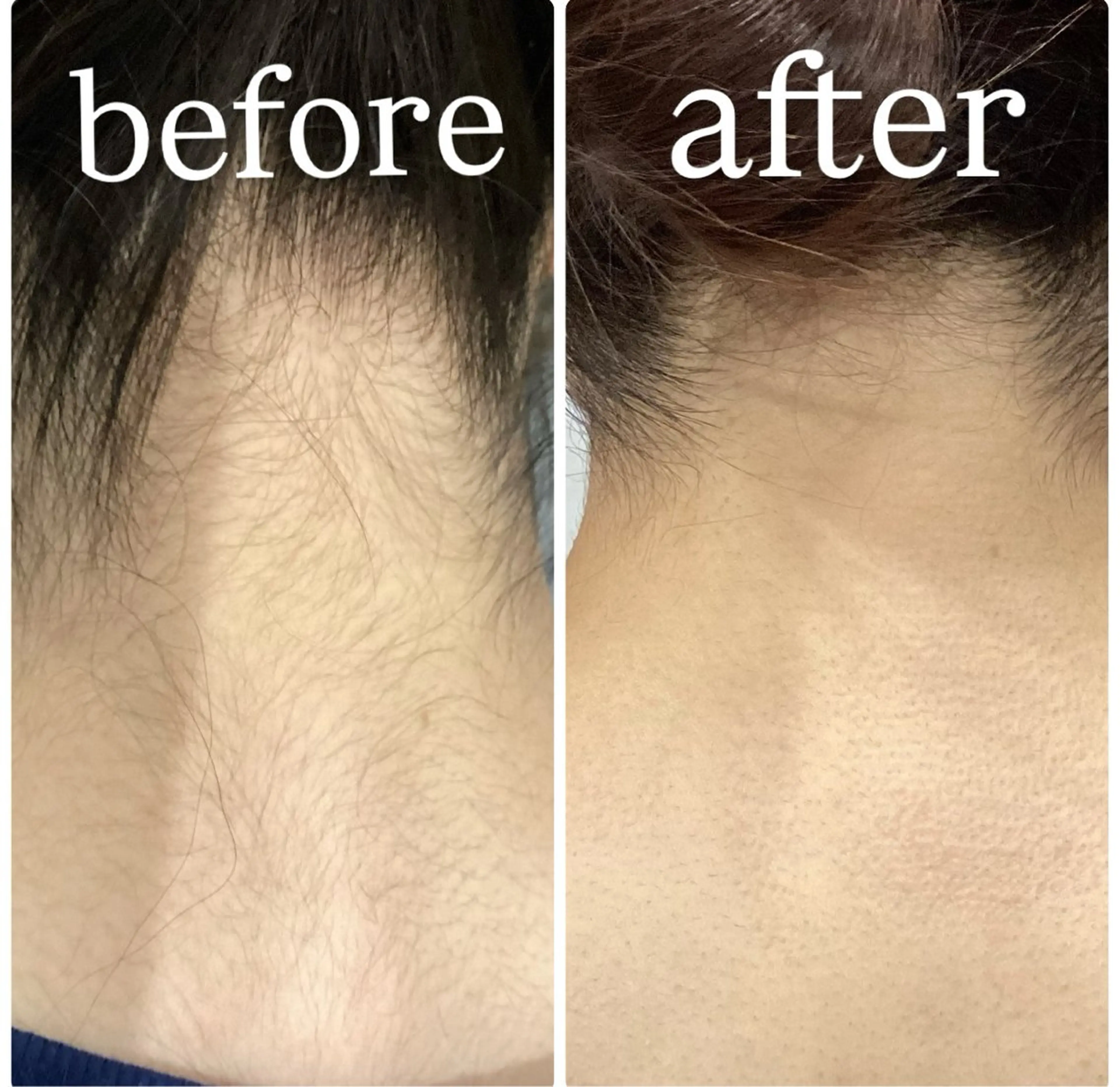 後ろ姿美人✨うなじ脱毛お試し　2,200円の写真