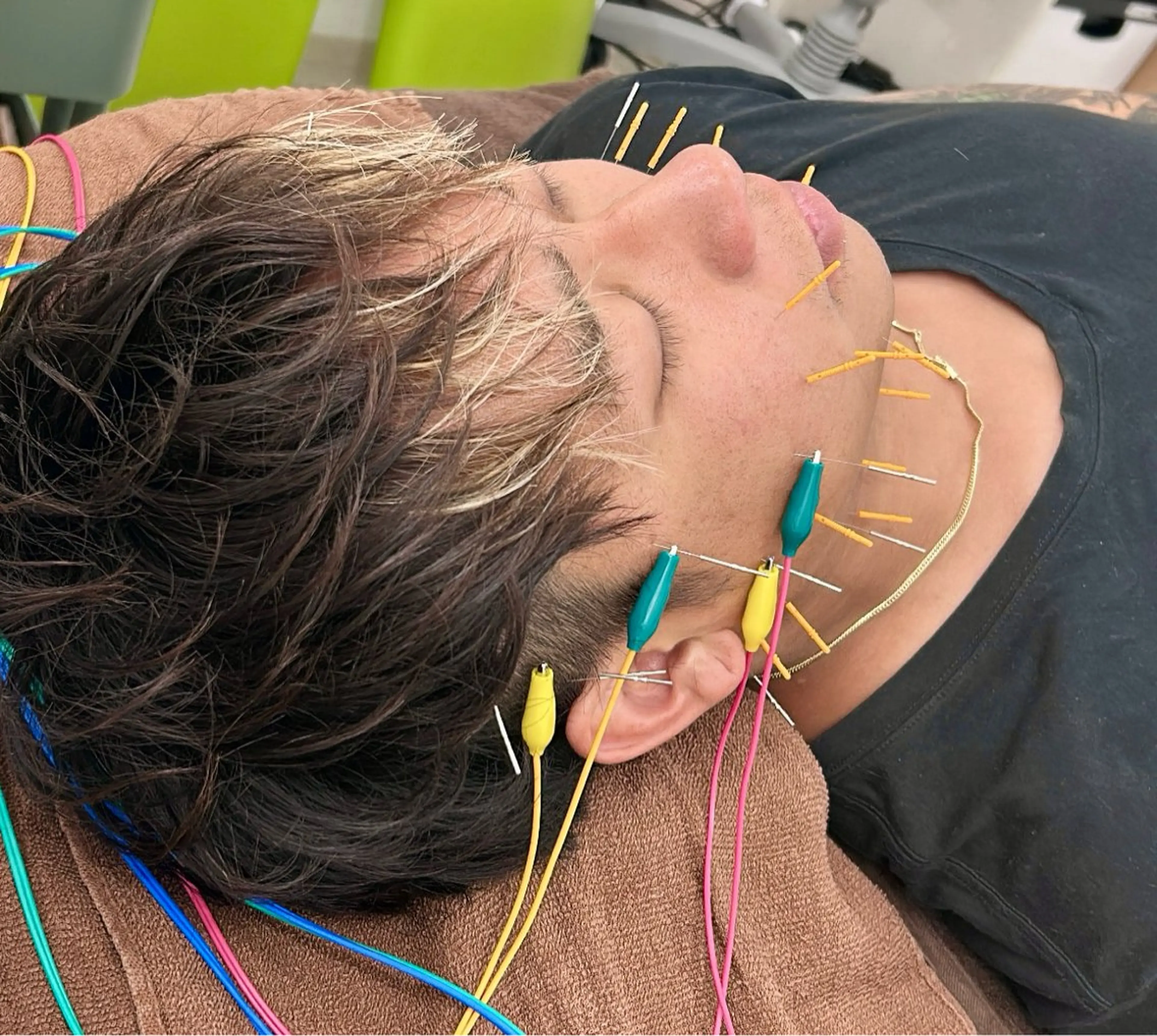 メンズ美容鍼の写真