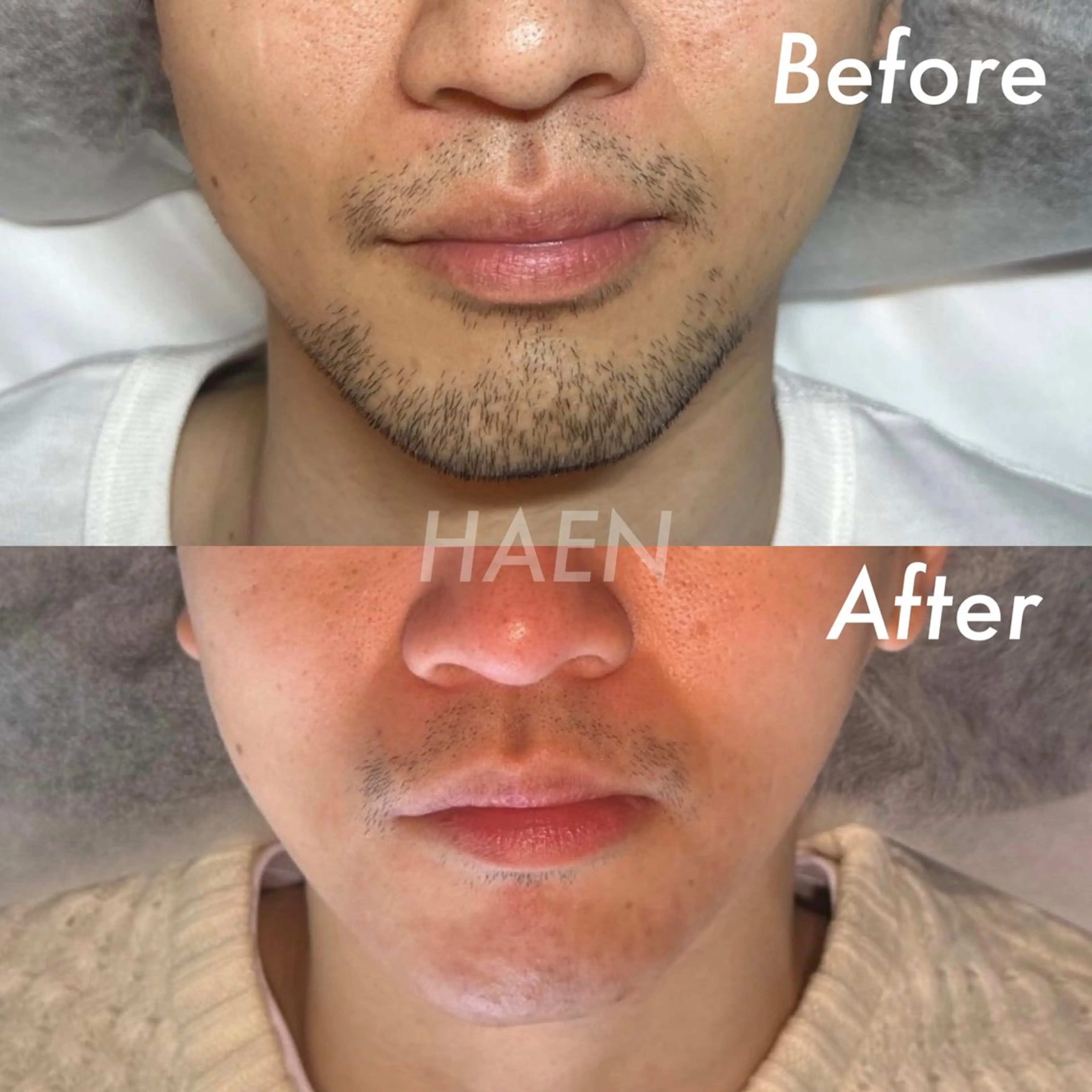 メンズ メンズ専門　ニードル脱毛サロン　HAEN所属・美容電気脱毛サロン HAENのエステ・リラクイメージ