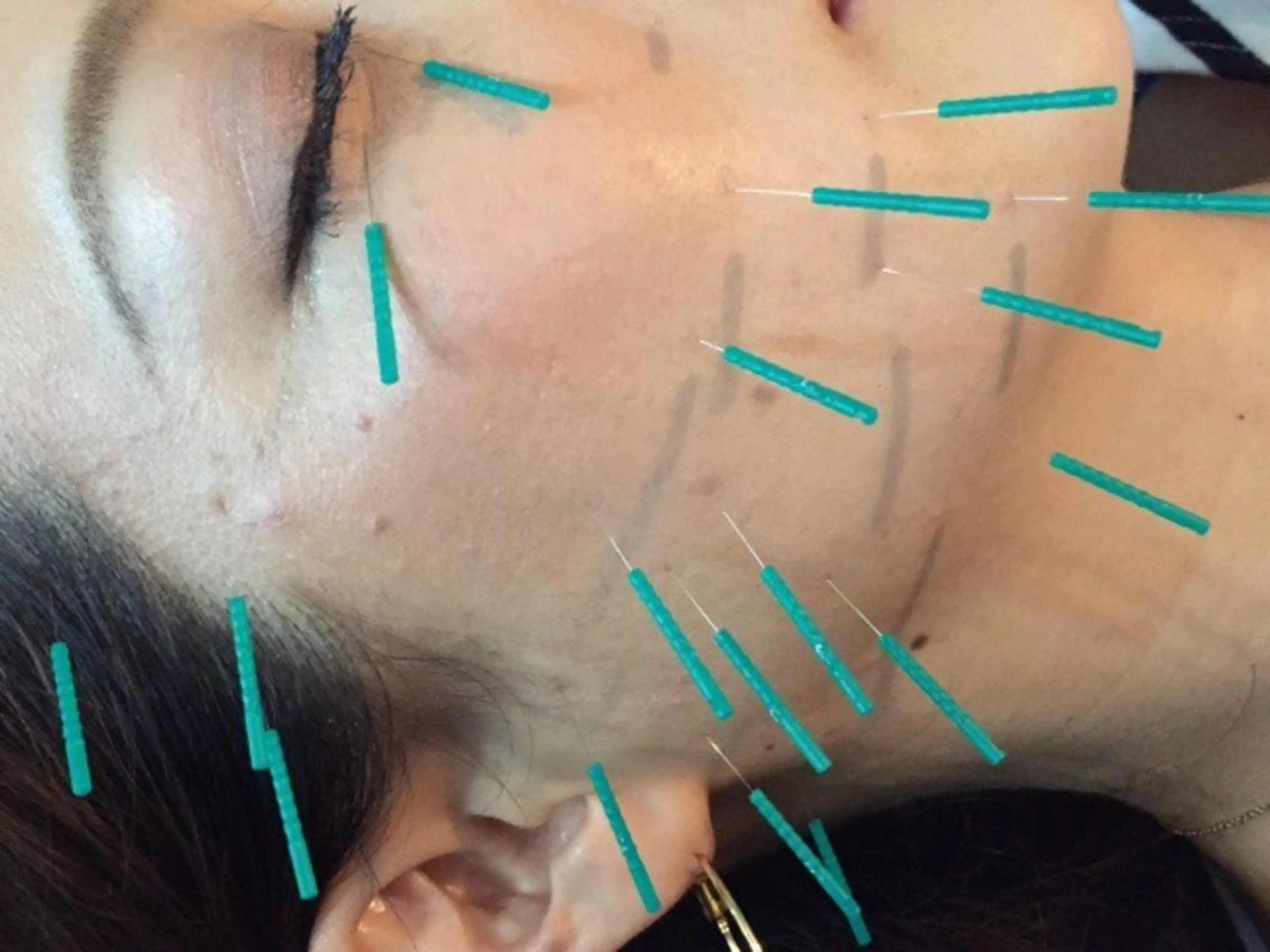小顔になれる美容鍼30本 ヘッドマッサージ付き🎶お顔のむくみ解消、ターンオーバーを整える!の写真