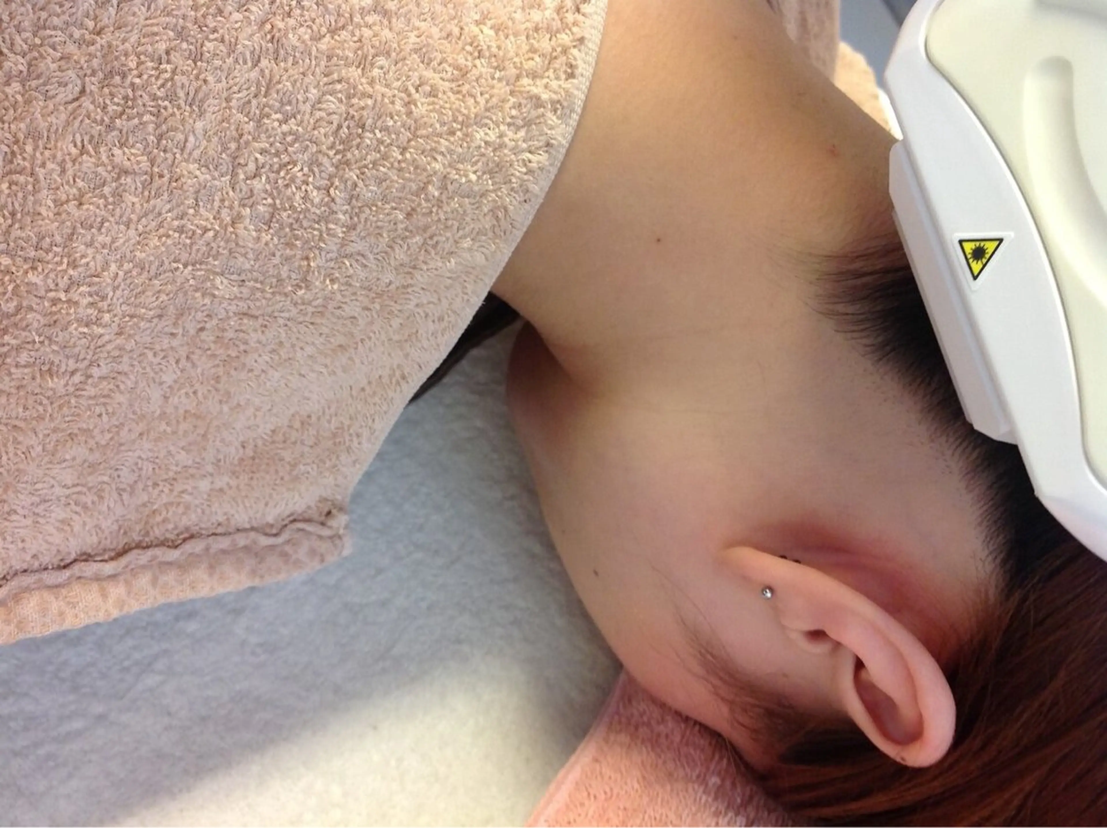 アップスタイルに自信を！【襟足、背中脱毛✨】の写真