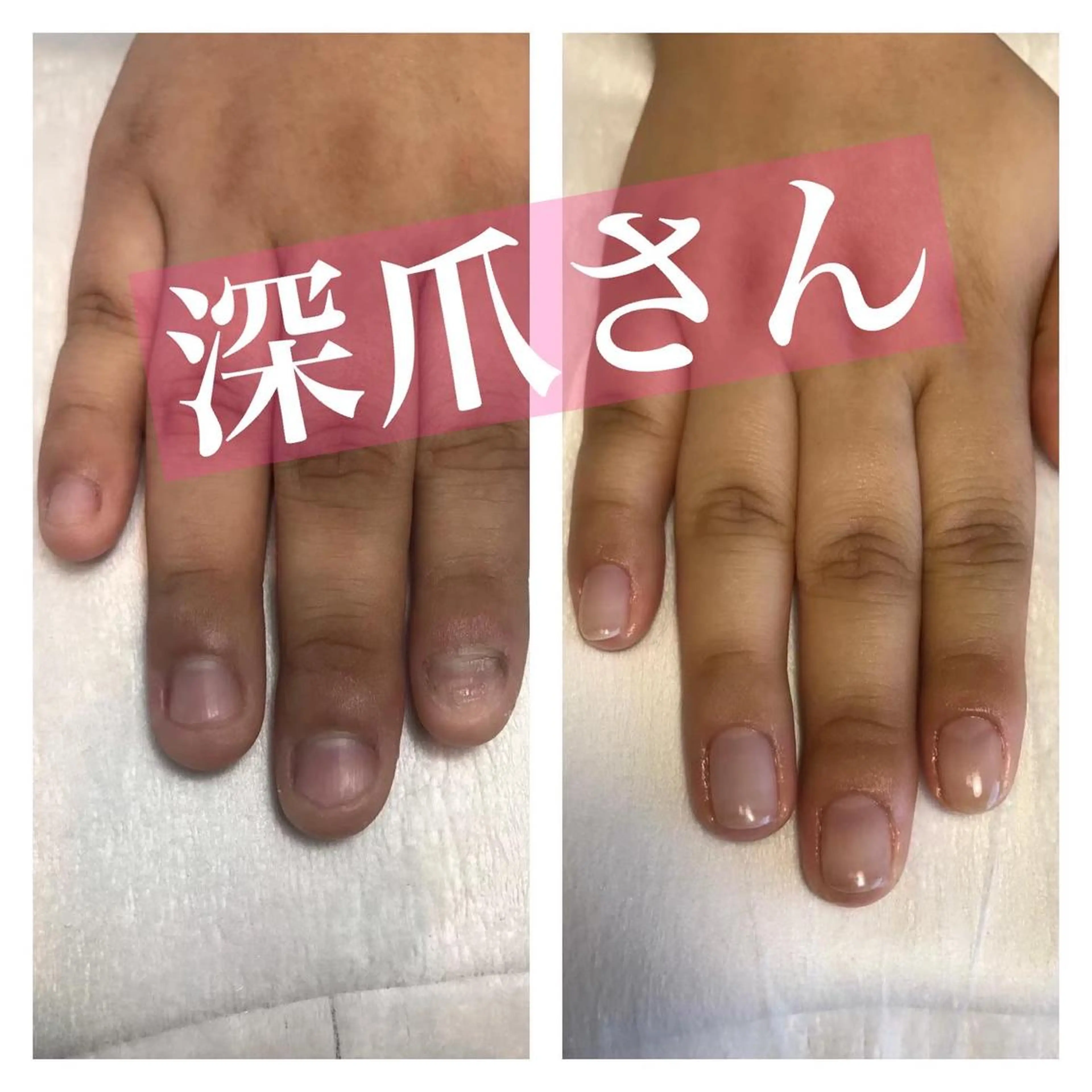 【深爪育成】深爪、かみ癖に悩む方へ　2回コースの写真