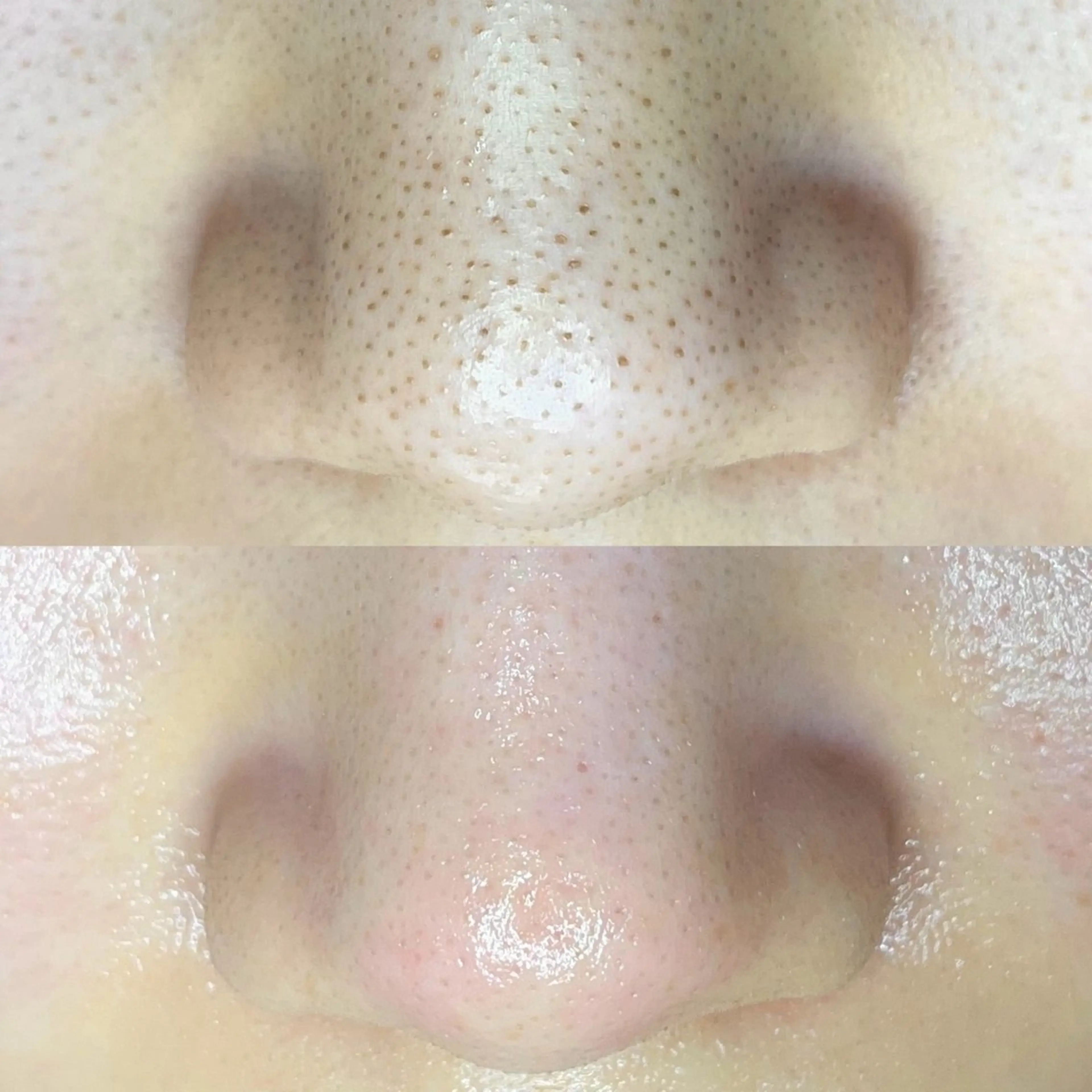 〈Aプラン〉毛穴ゼロシンプルコースの写真