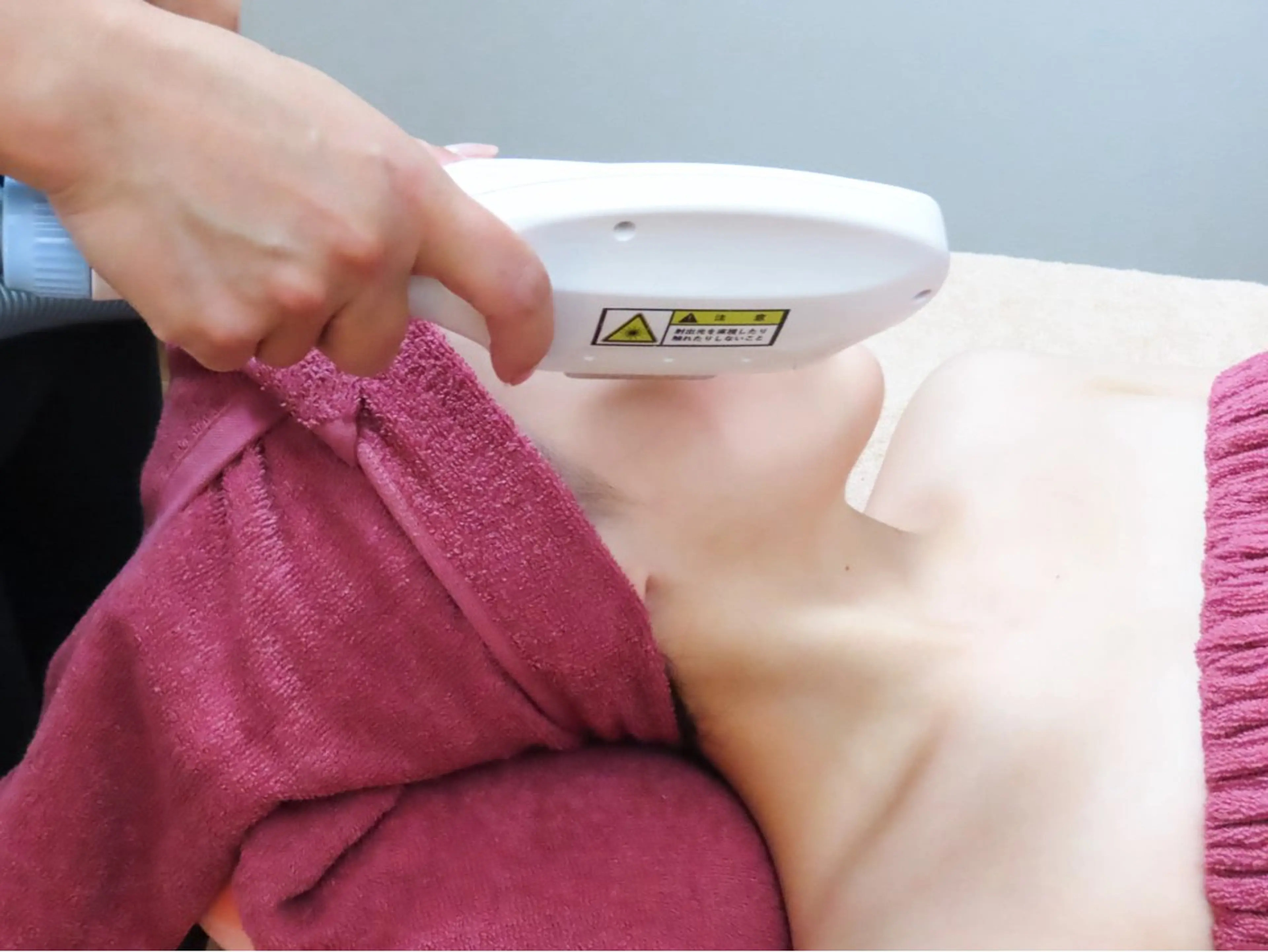 レディース顔脱毛1回の写真