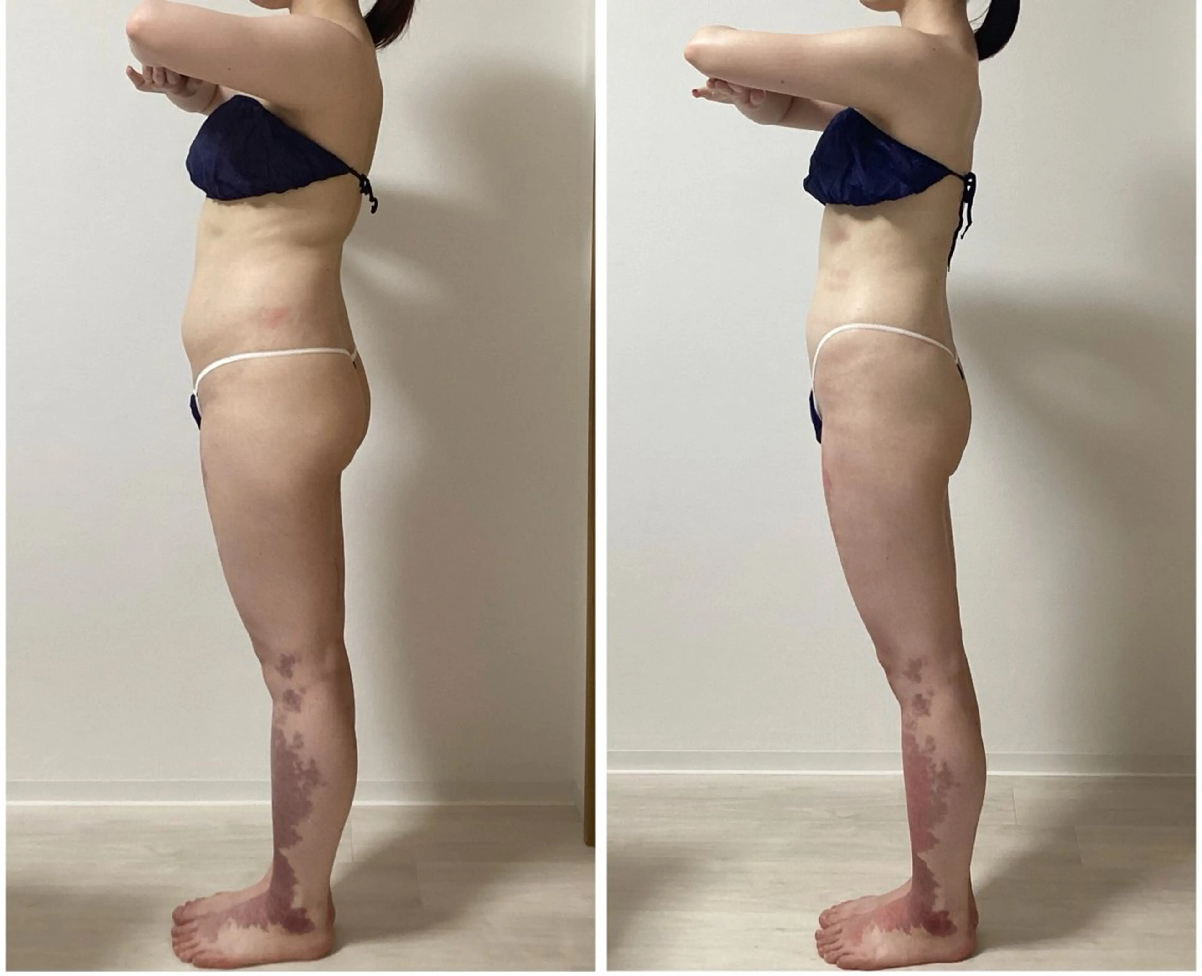 エステ ハイパーナイフ痩身 Misakiのエステ・リラクイメージ