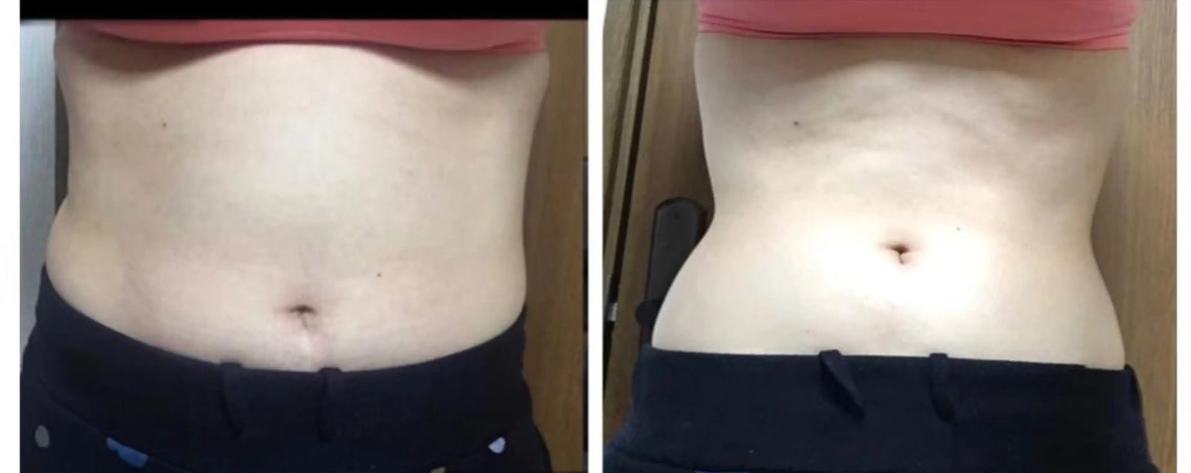 【女性のみ🙆‍♀️くびれ集中ケア】お腹周りセルライトケアコース&保湿ケア付きの写真