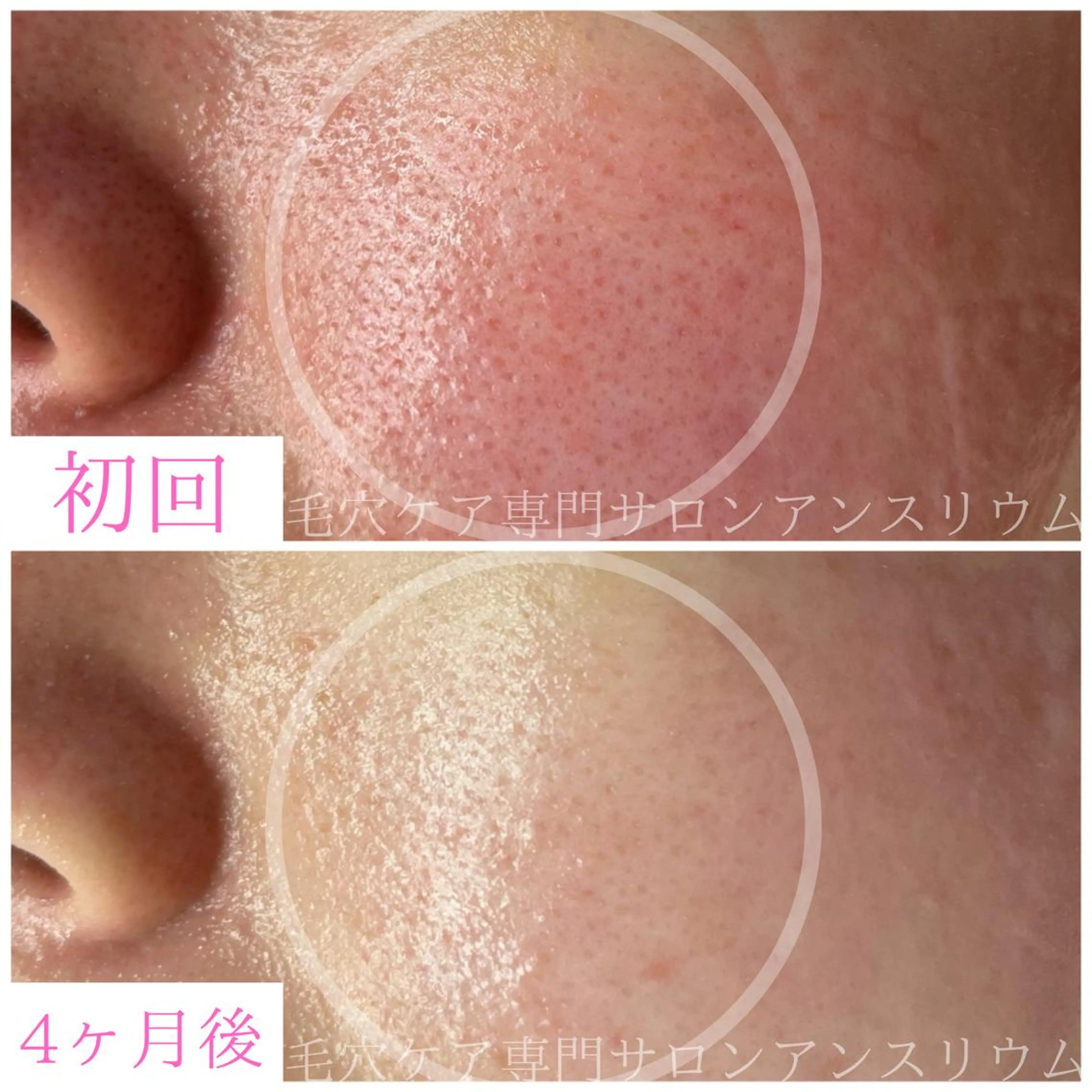 毛穴ケア専門サロンアンスリウム所属・茨城土浦 つくば毛穴 ケア専門サロンのエステ・リラクイメージ