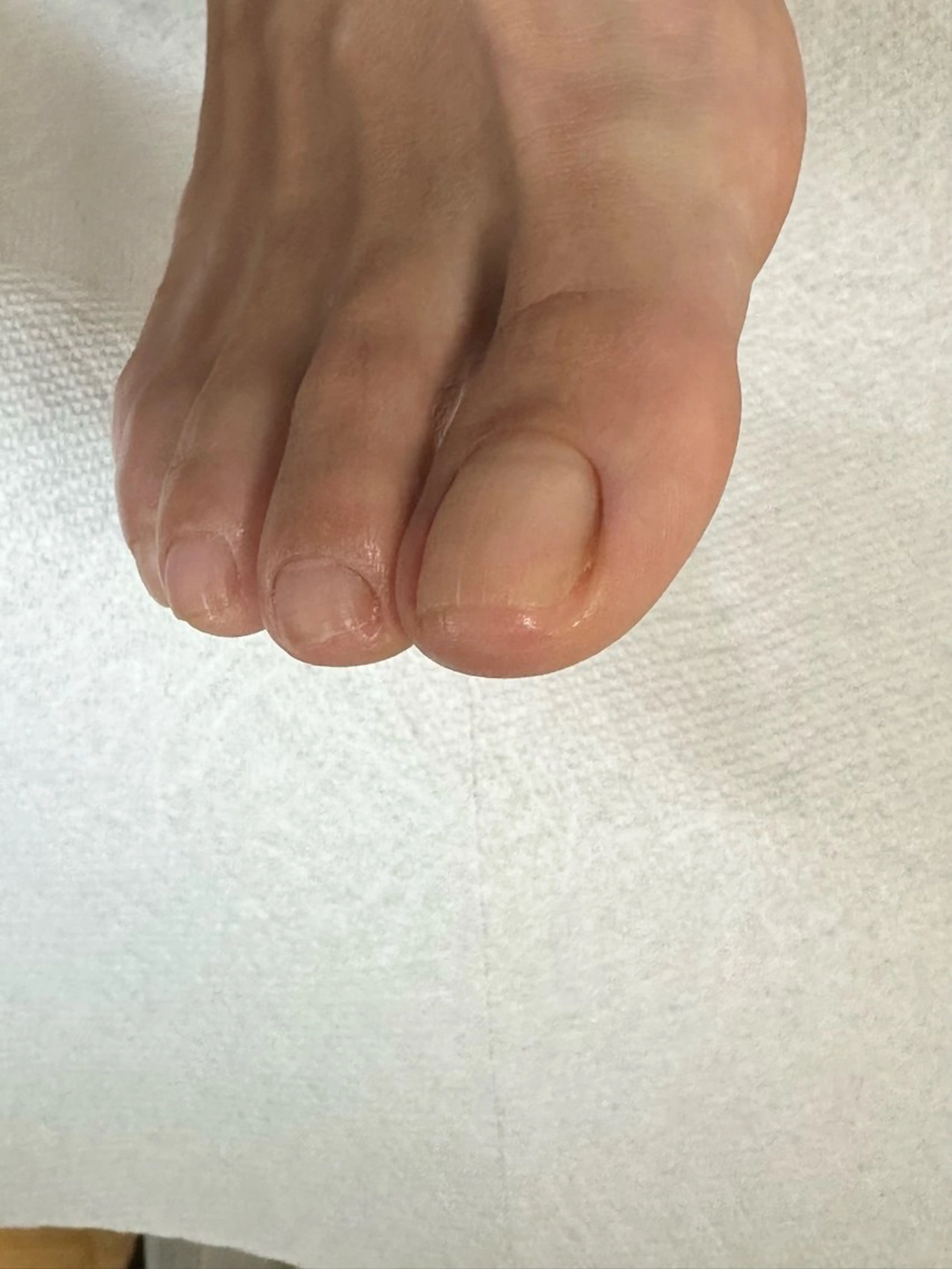 巻き爪緩和ケアモニターの写真