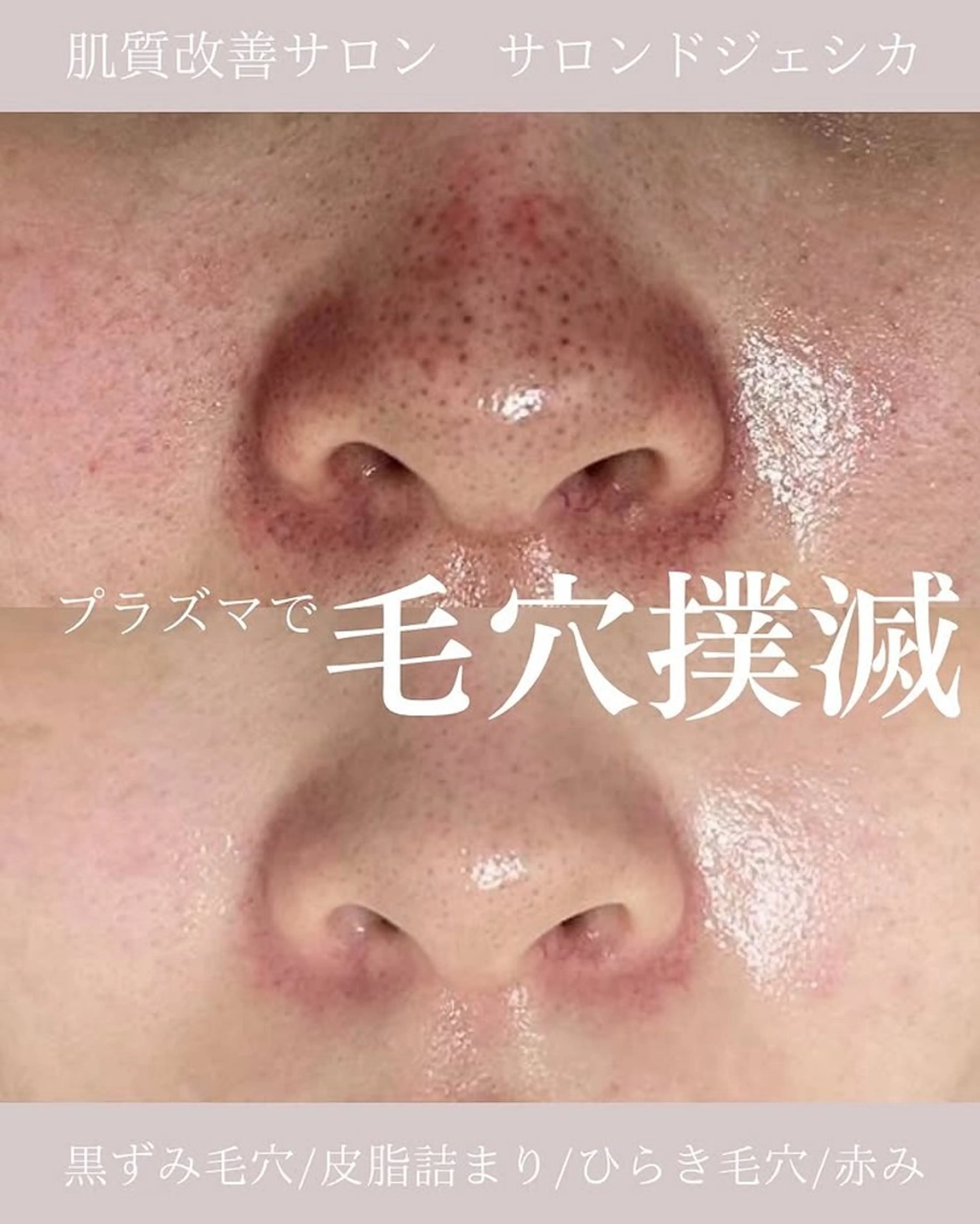 【ミニモ限定❗️SNSでも話題の毛穴革命✨】プラズマフェイシャル毛穴洗浄or美肌フォト肌管理コースの写真