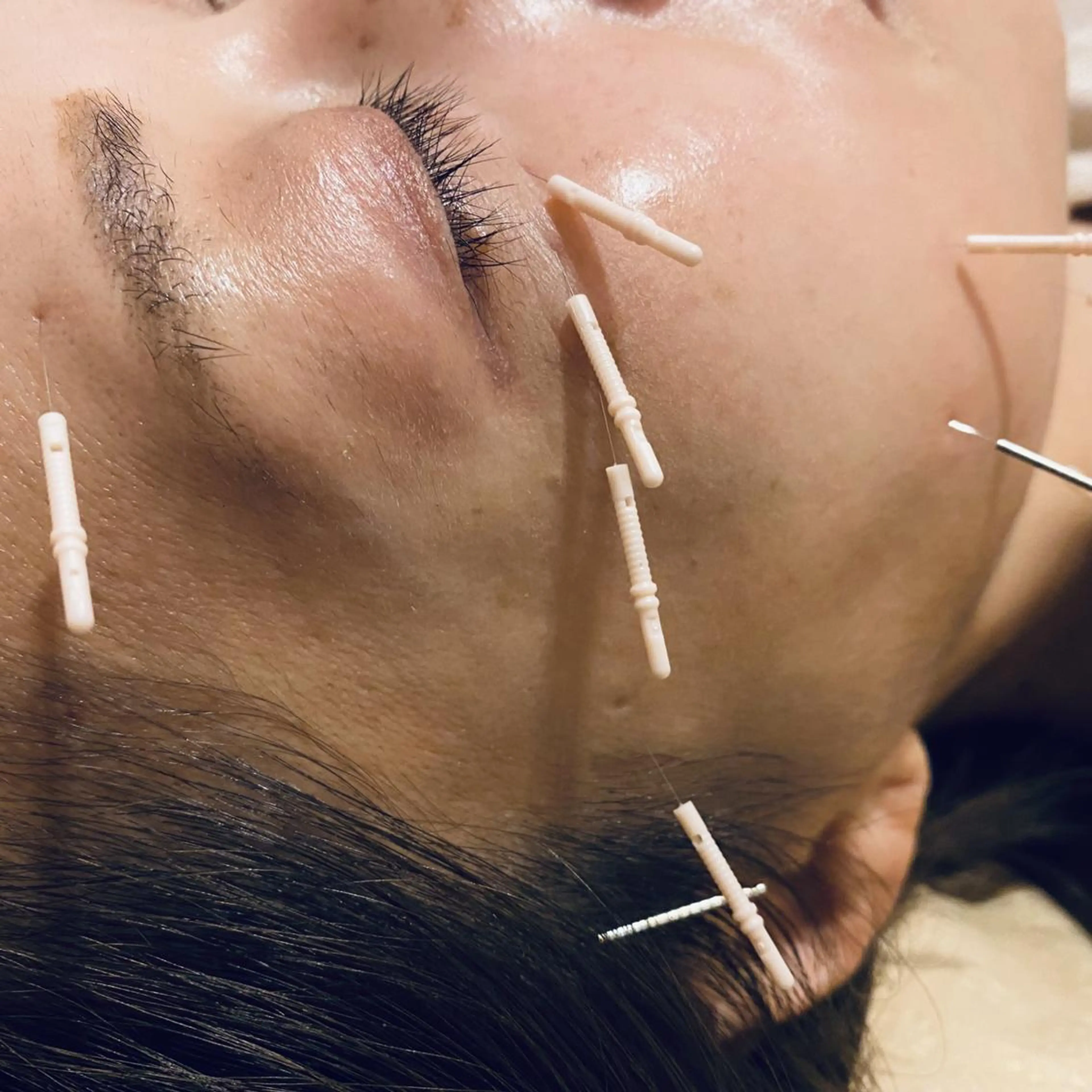 むくみたるみ専門☆ 美容鍼・小顔矯正のエステ・リラクイメージ