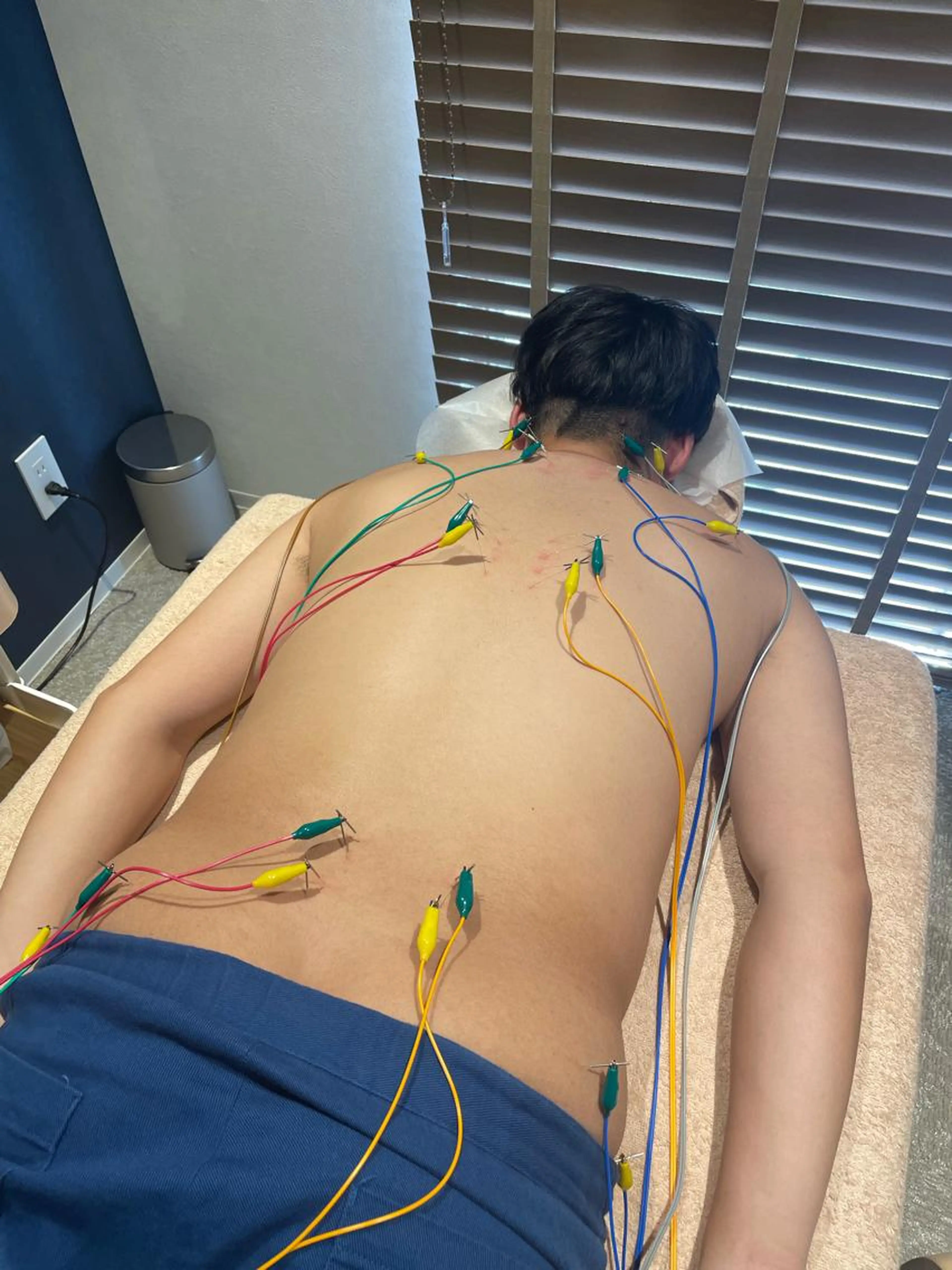 背面電気鍼【デスクワーク、腰痛、肩こりの方向け✨】の写真