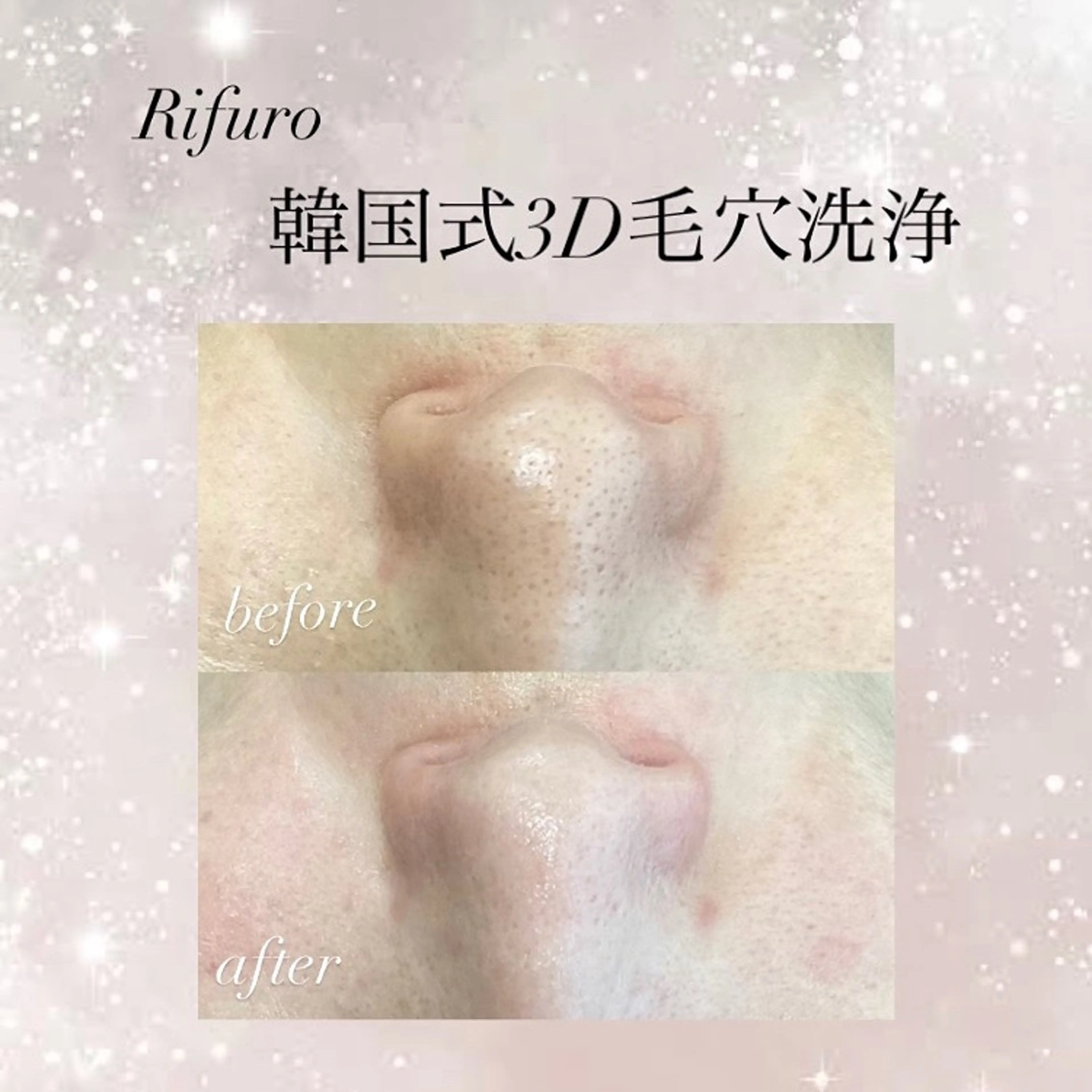 エステ Rifuro 勝田台エステ所属・Rifuro勝田台 ララピール・毛穴洗浄のエステ・リラクイメージ