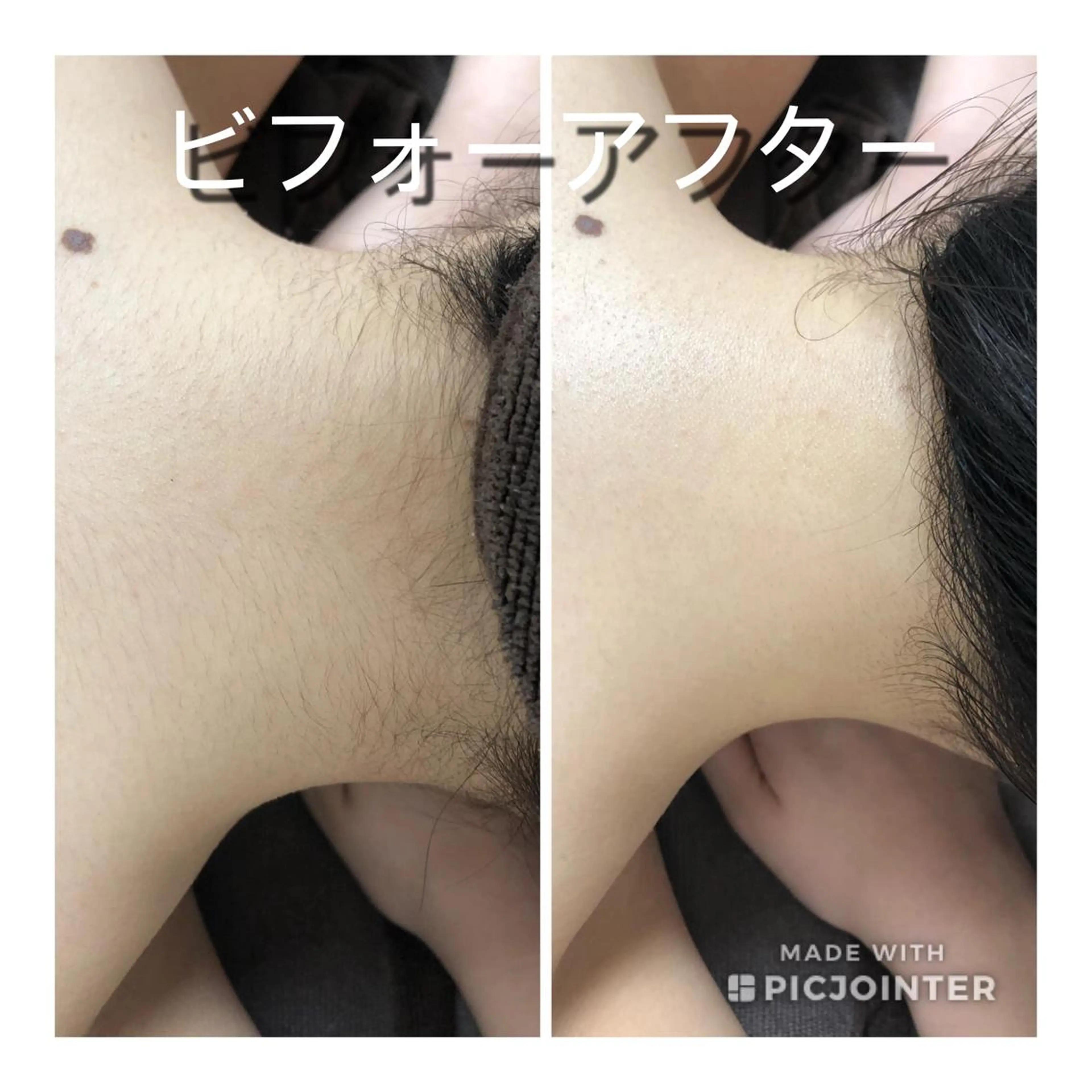 全身美肌脱毛　ライトプラン（顔とVIO以外）夏場に向けて今からツルスベ肌へ、、✨😍2回目以降の写真