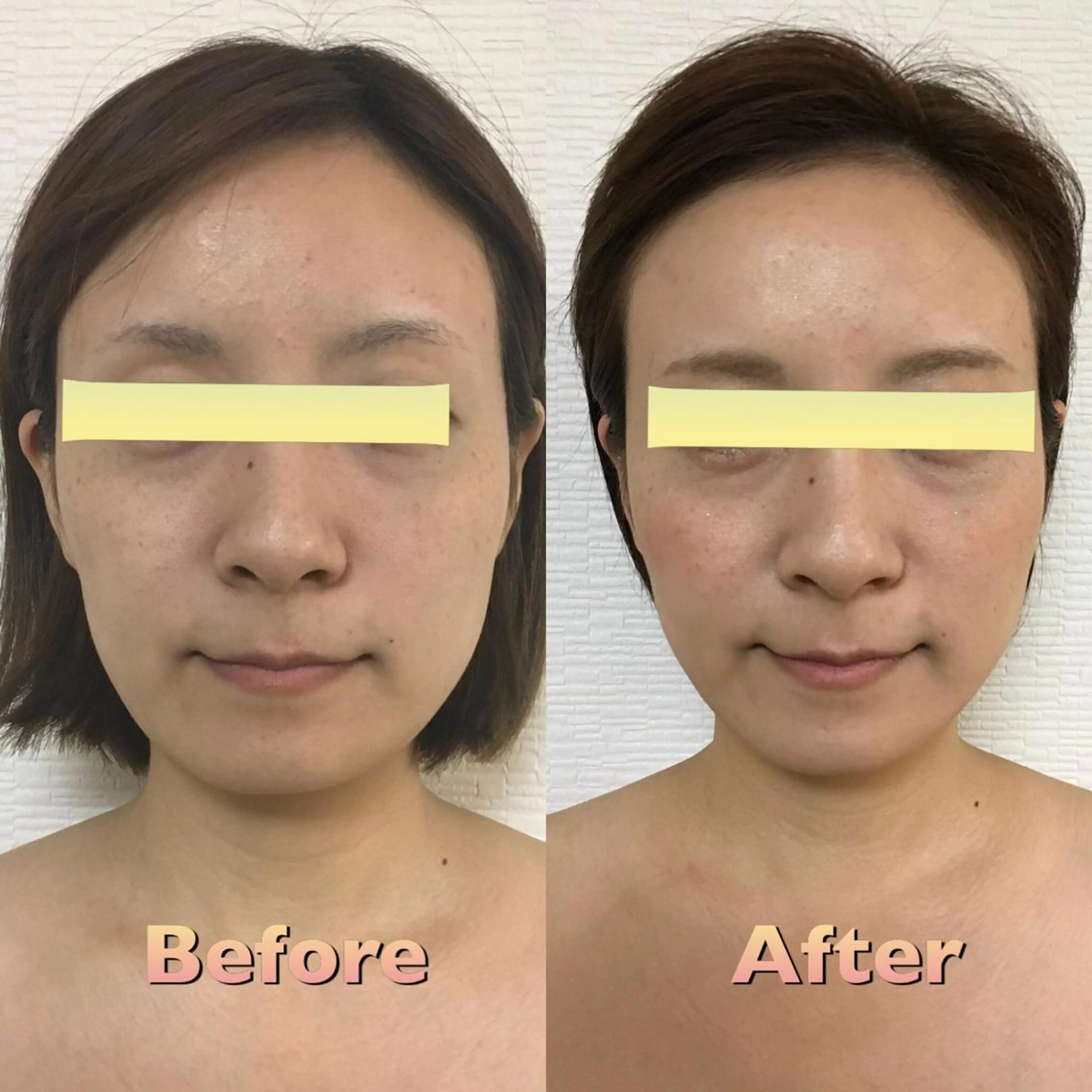 🎄12月5名様限定💎　人気No.1 小顔筋膜矯正45分の写真