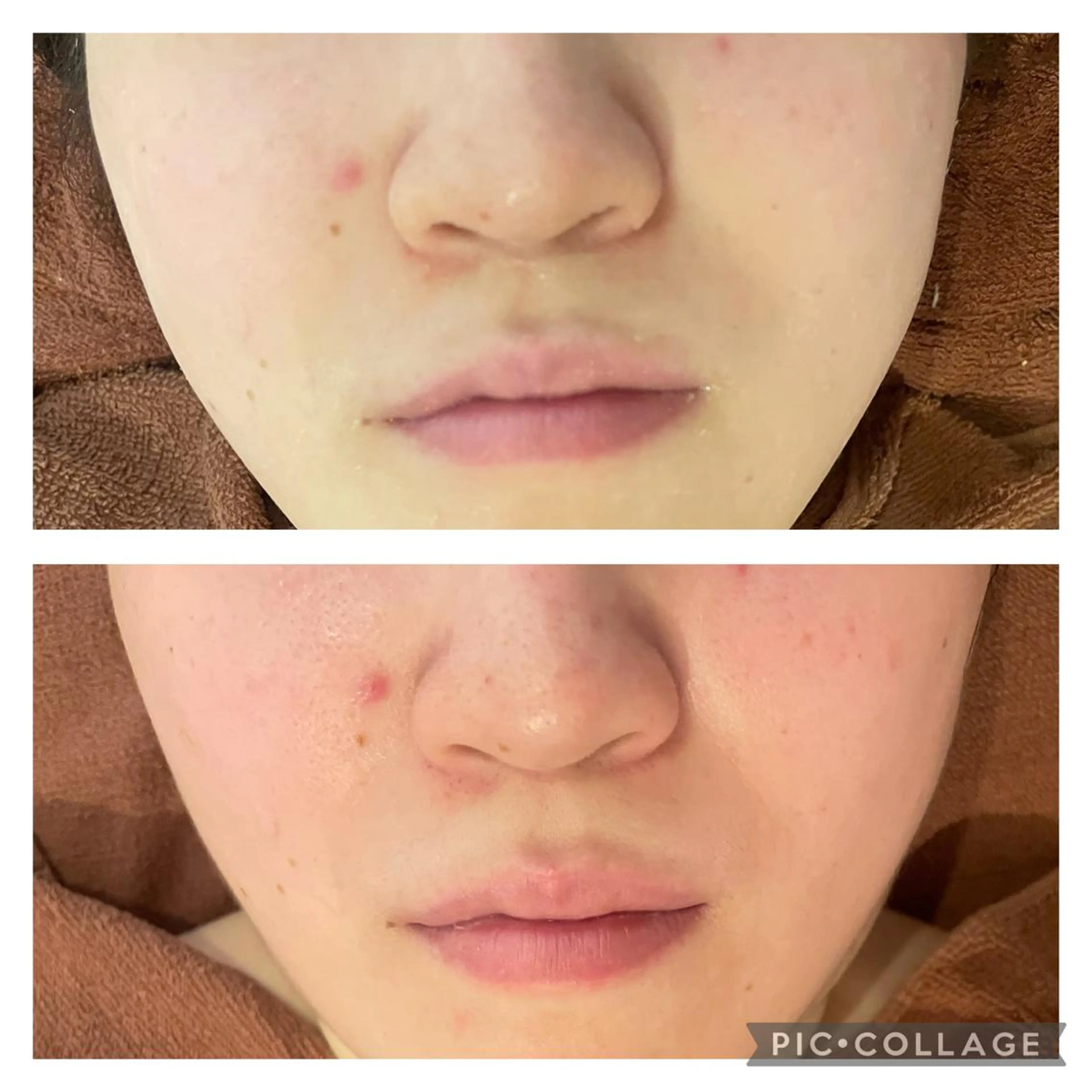 ロング カラー パーマ ヘアアレンジ メンズ キッズ ネイル マツエク・マツパ アイブロウ エステ リラク ニキビ特化型エステ 🍓最短で肌質改善のエステ・リラクイメージ