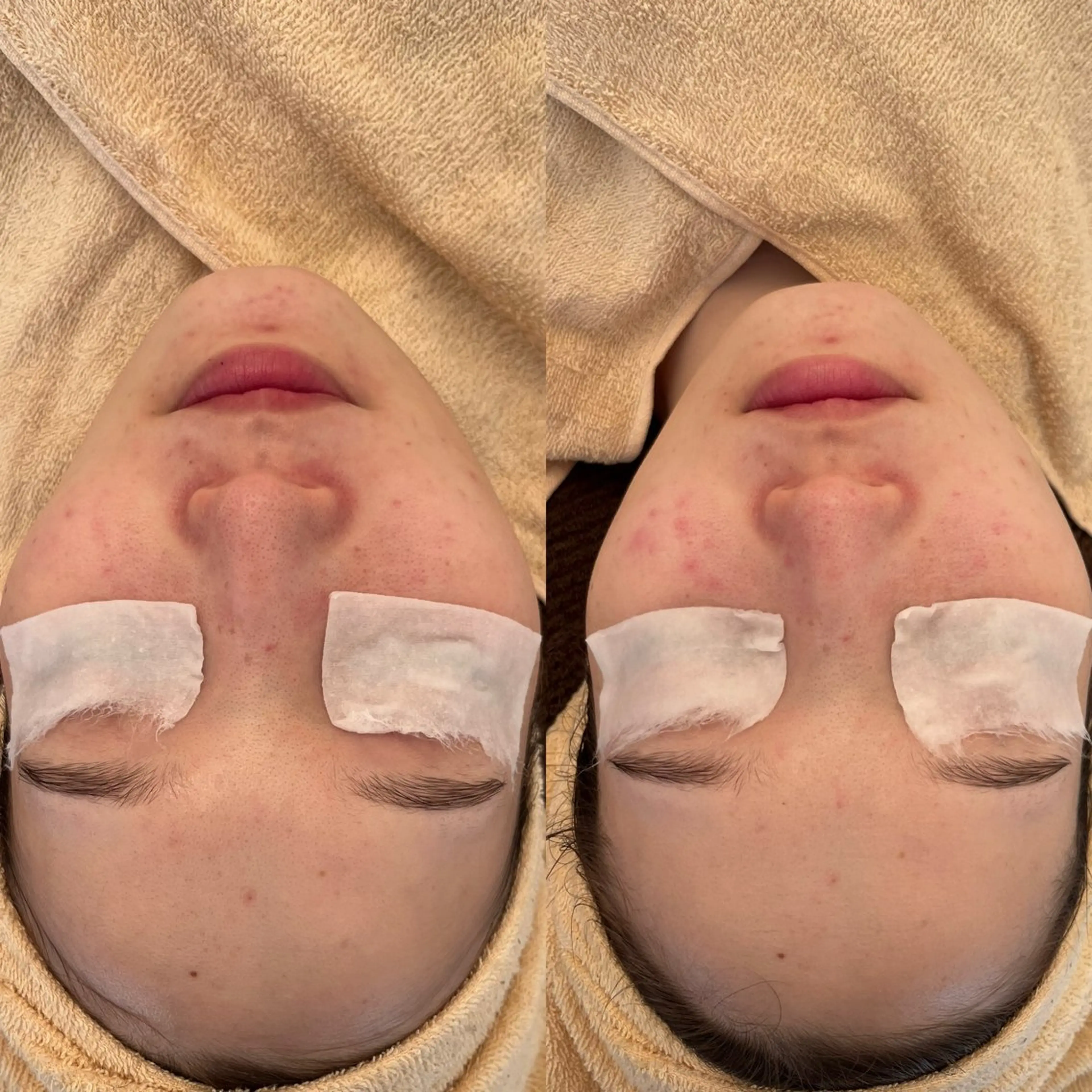 エステ 毛穴ケア/毛穴診断/ 毛穴洗浄〔心斎橋〕のエステ・リラクイメージ