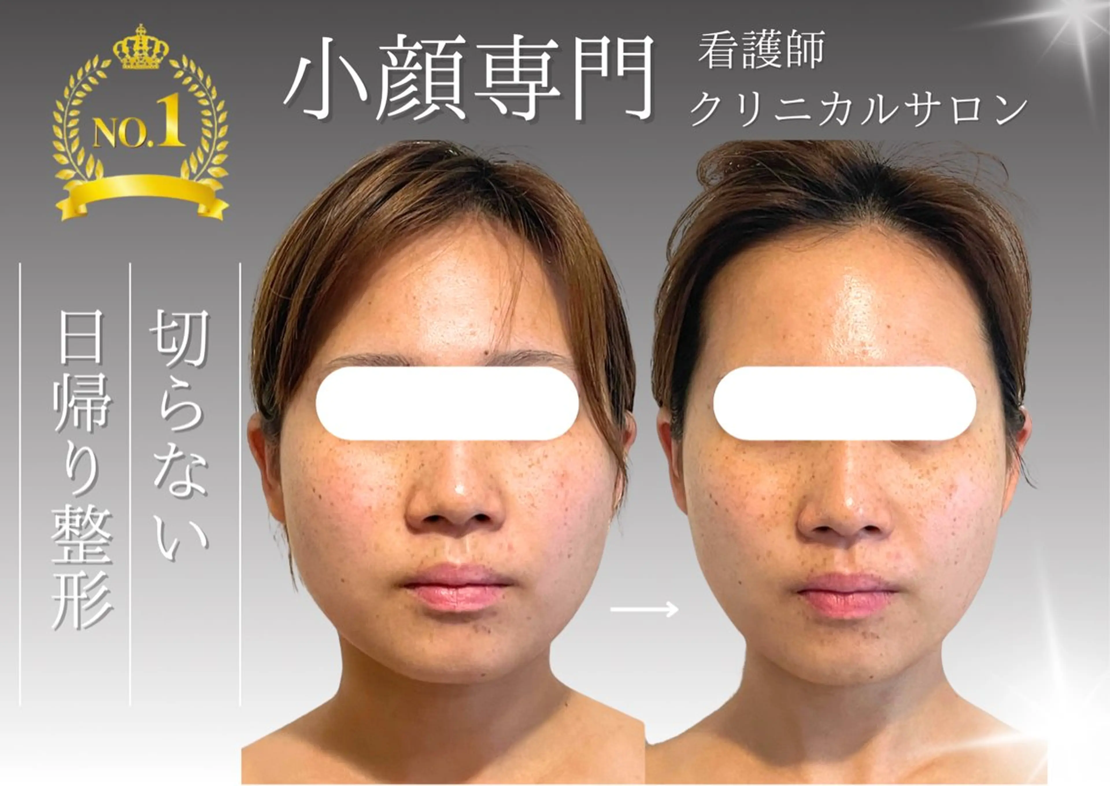 人気No.1🏆【最新小顔施術×ヒアル導入】お顔造形フルコース。完全看護師施術でクリニックレベルの結果だし！の写真