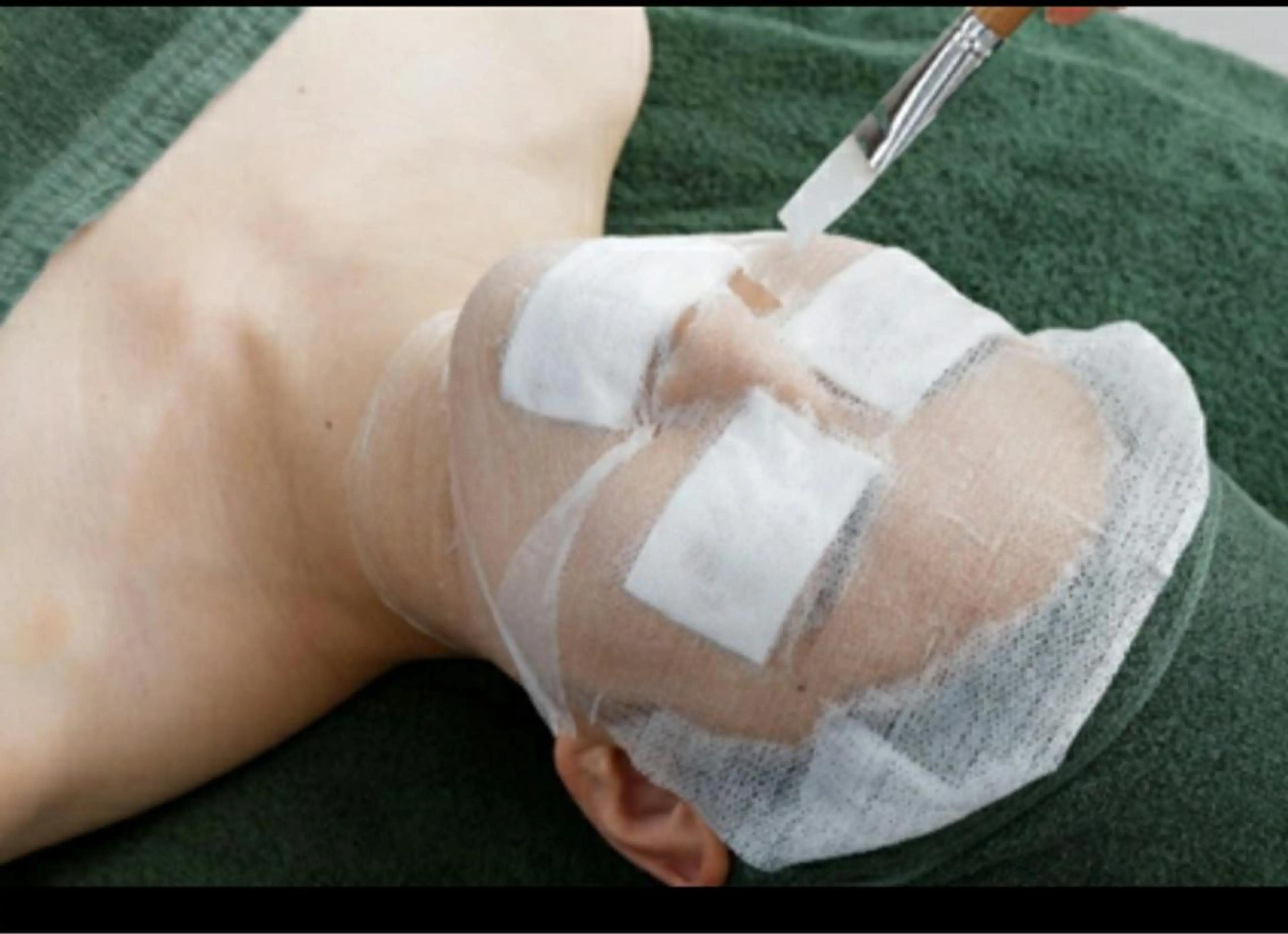 【バクテリウムピーリング】シンデレラコース100分の写真