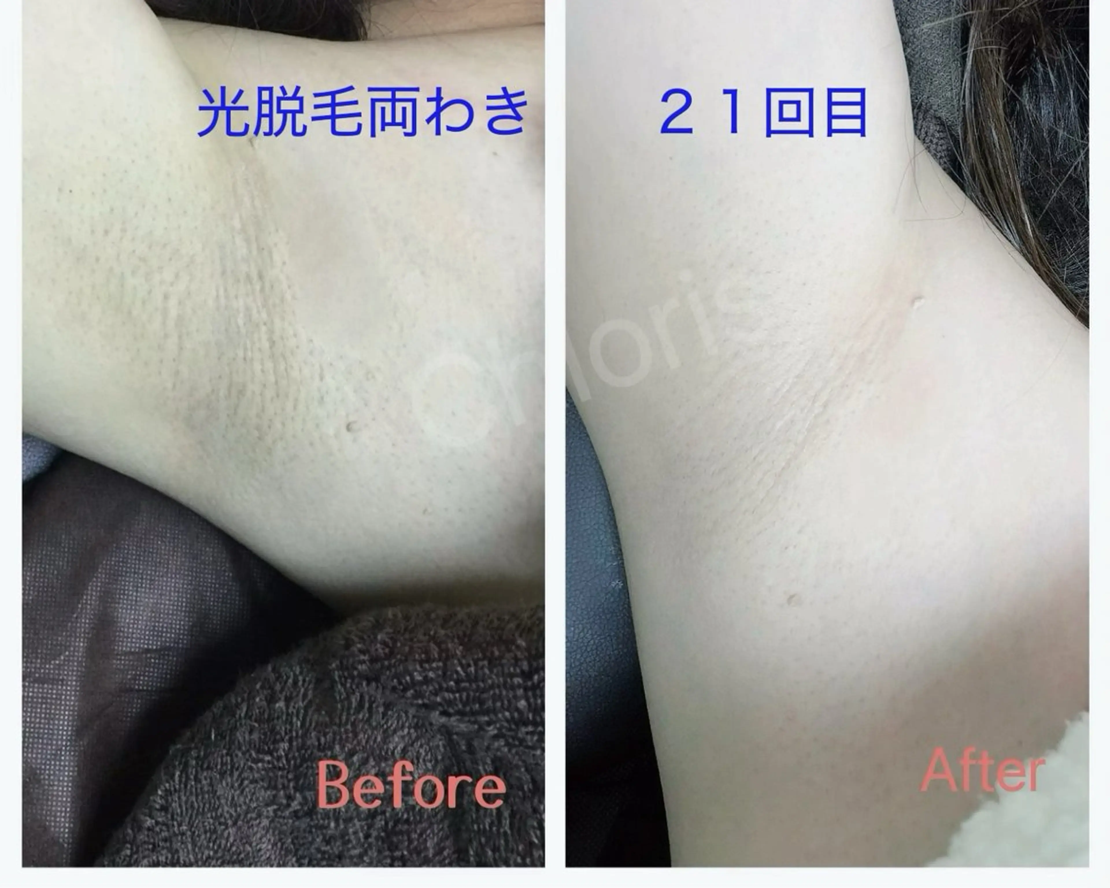【初回限定】　《光脱毛》両ワキ脱毛の写真