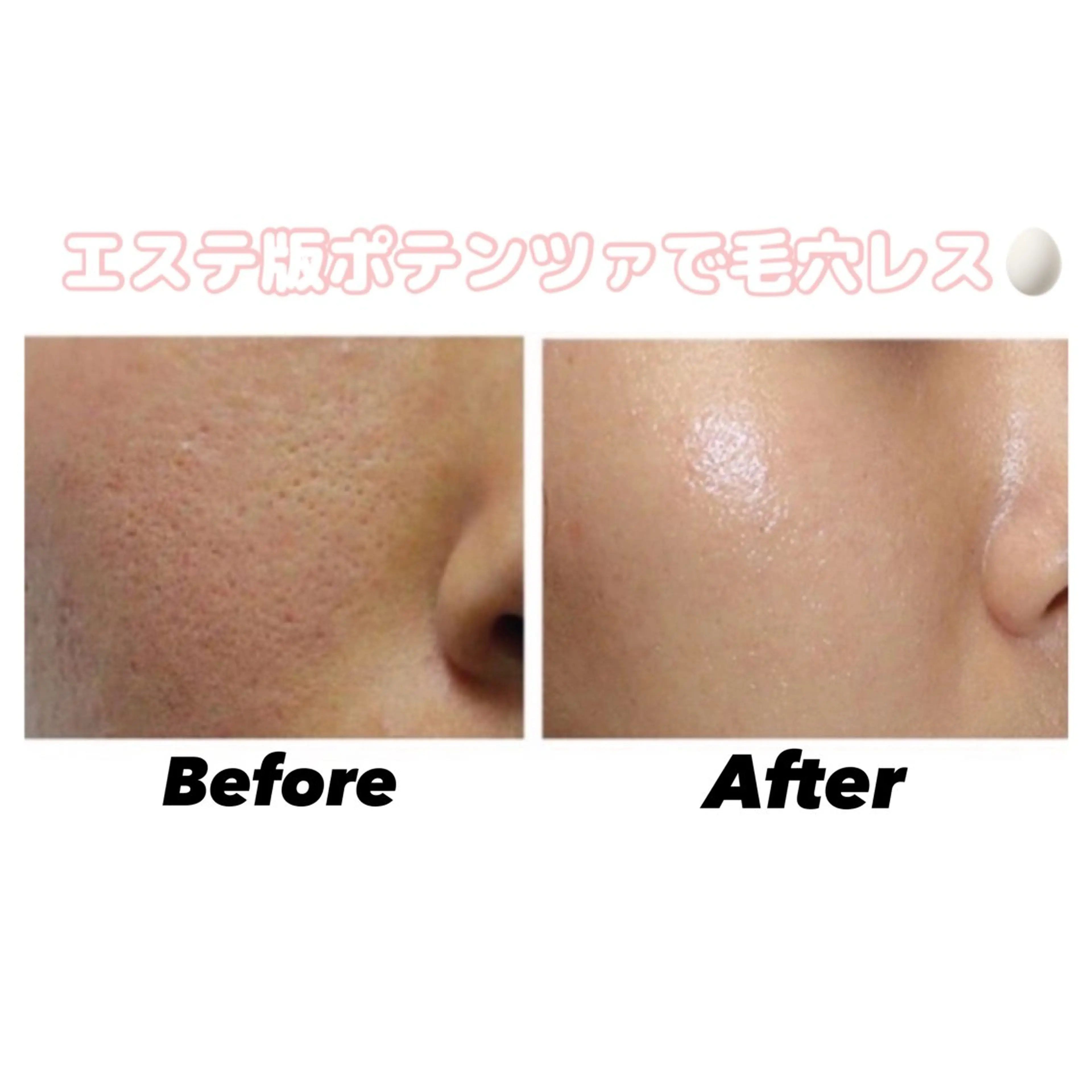 【毛穴ケア】毛穴洗浄×マイクロニードルで徹底的に毛穴ケア🥚✨️¥32,000⇒¥14,800の写真