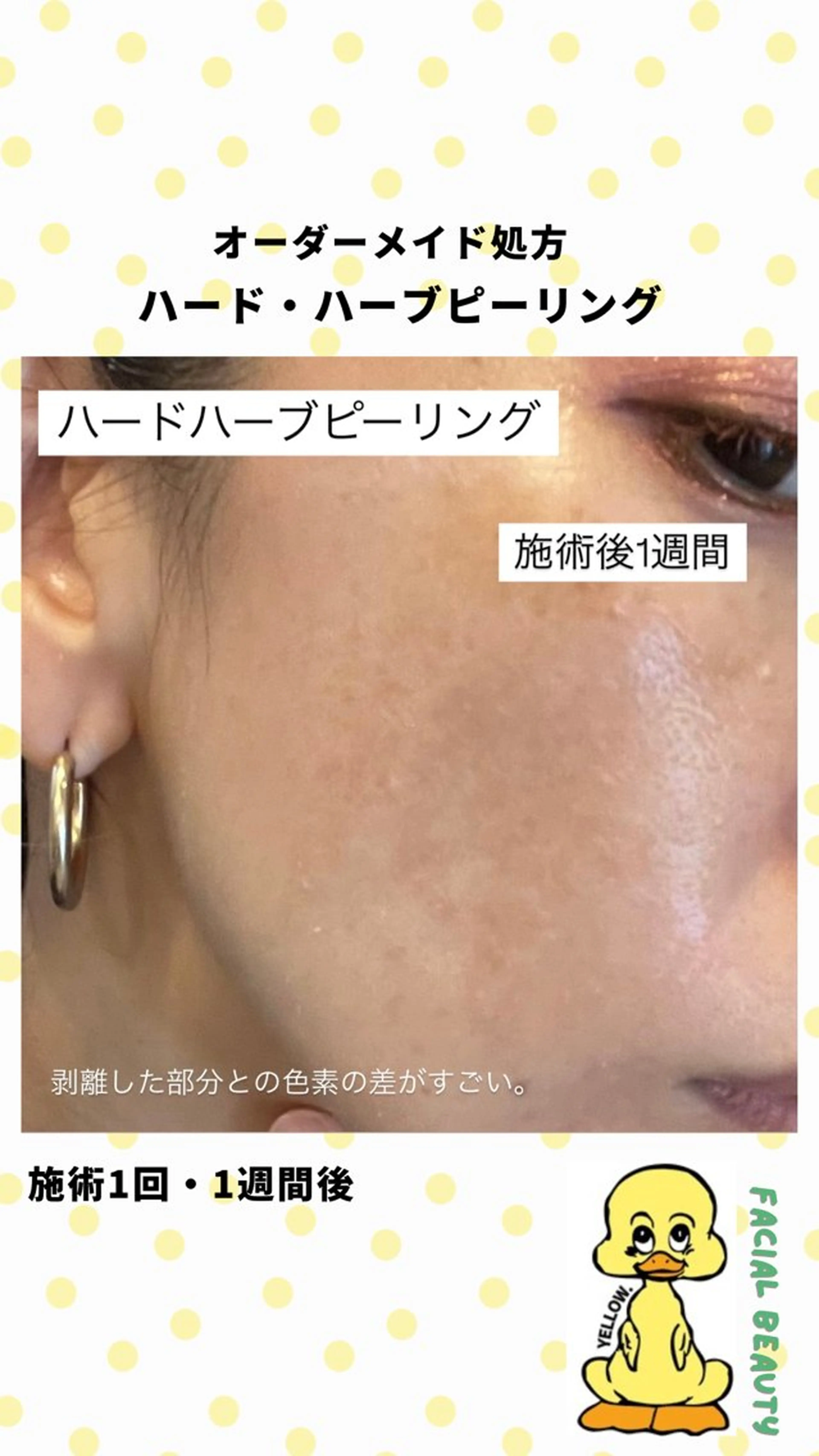 脱毛 yellow.所属・yellow💛【 脱毛&フェイシャル】のエステ・リラクイメージ