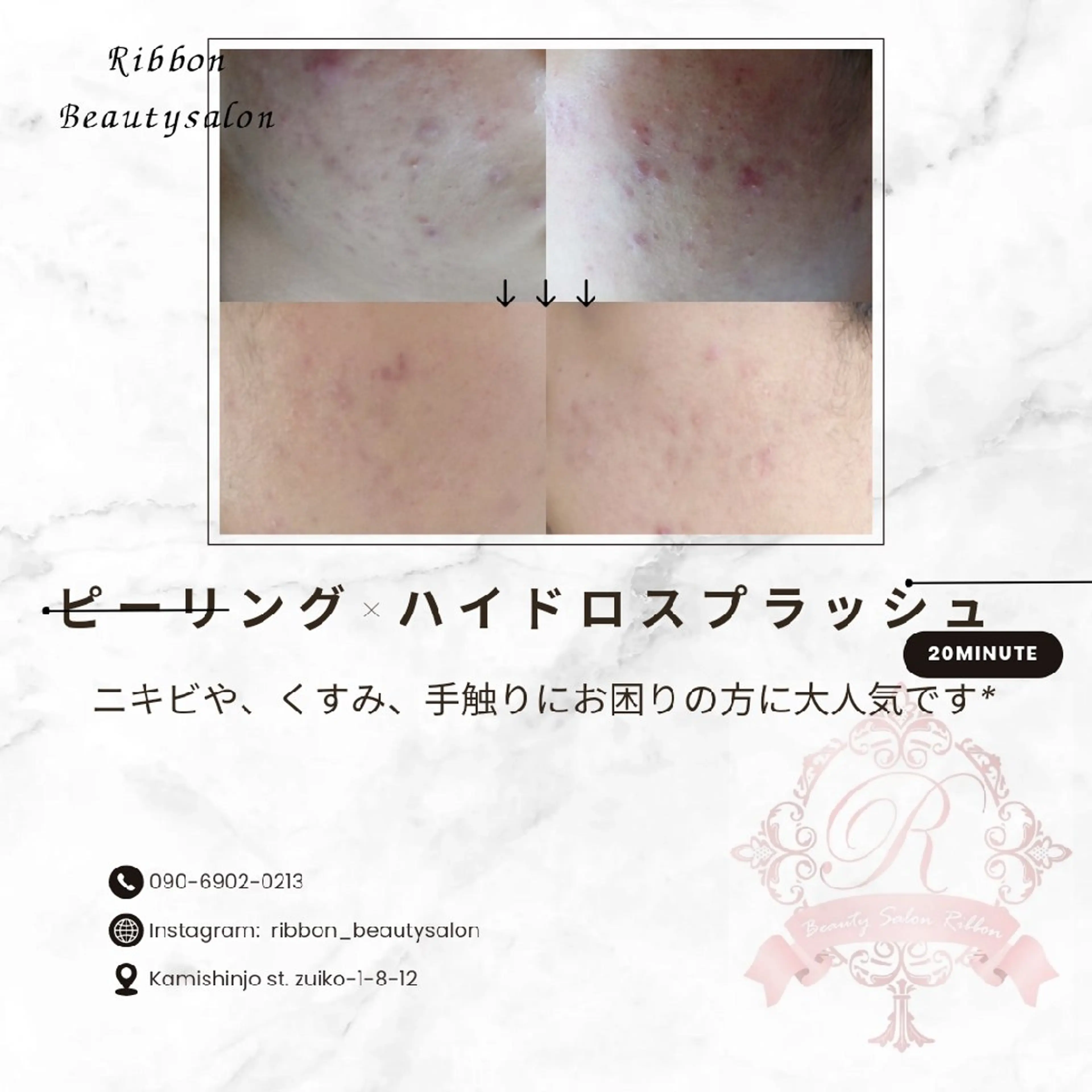 ニキビ知らず!!2回分!!話題のツルツル肌←ピーリング×ハイドロスプラッシュの写真