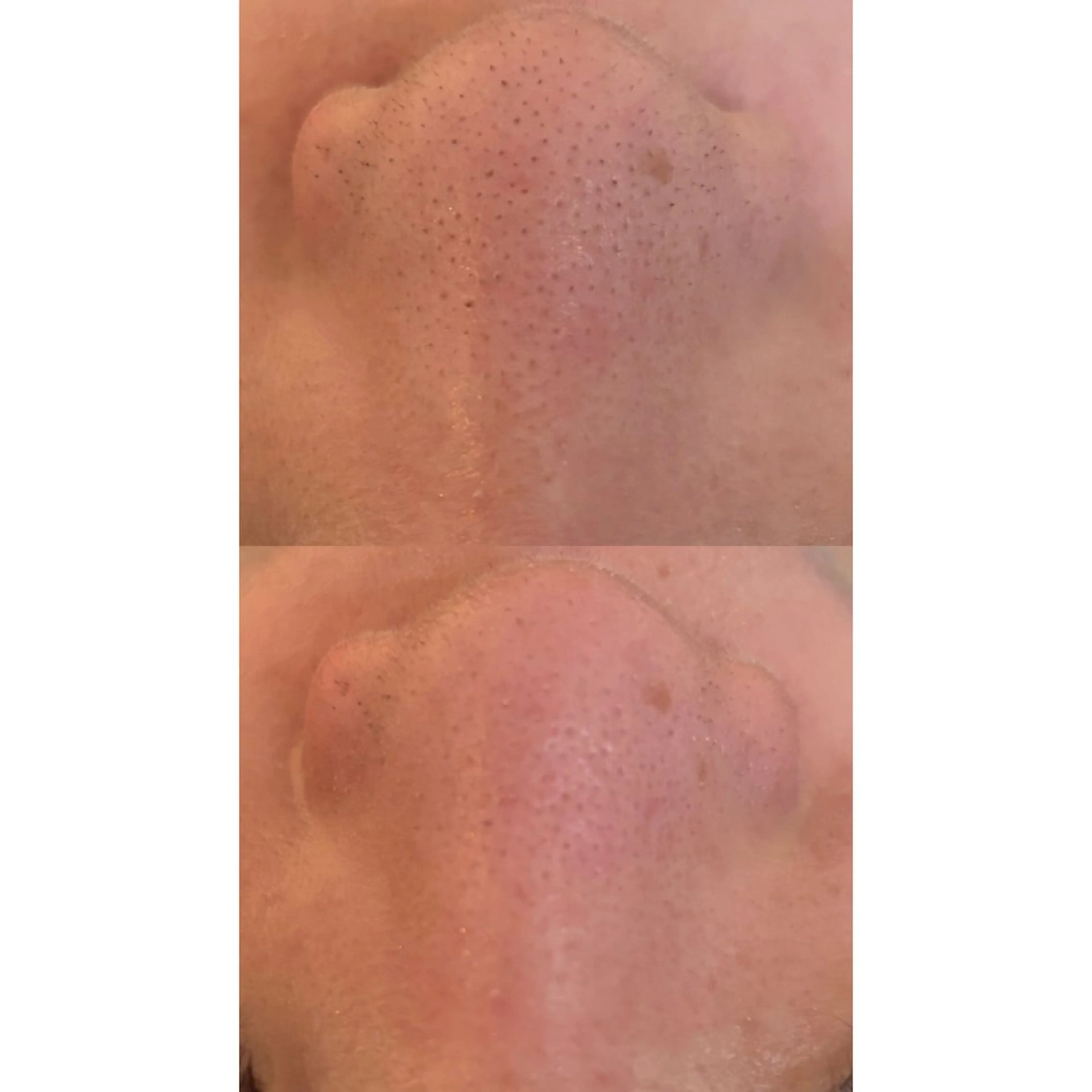 毛穴フェイシャルエステの写真