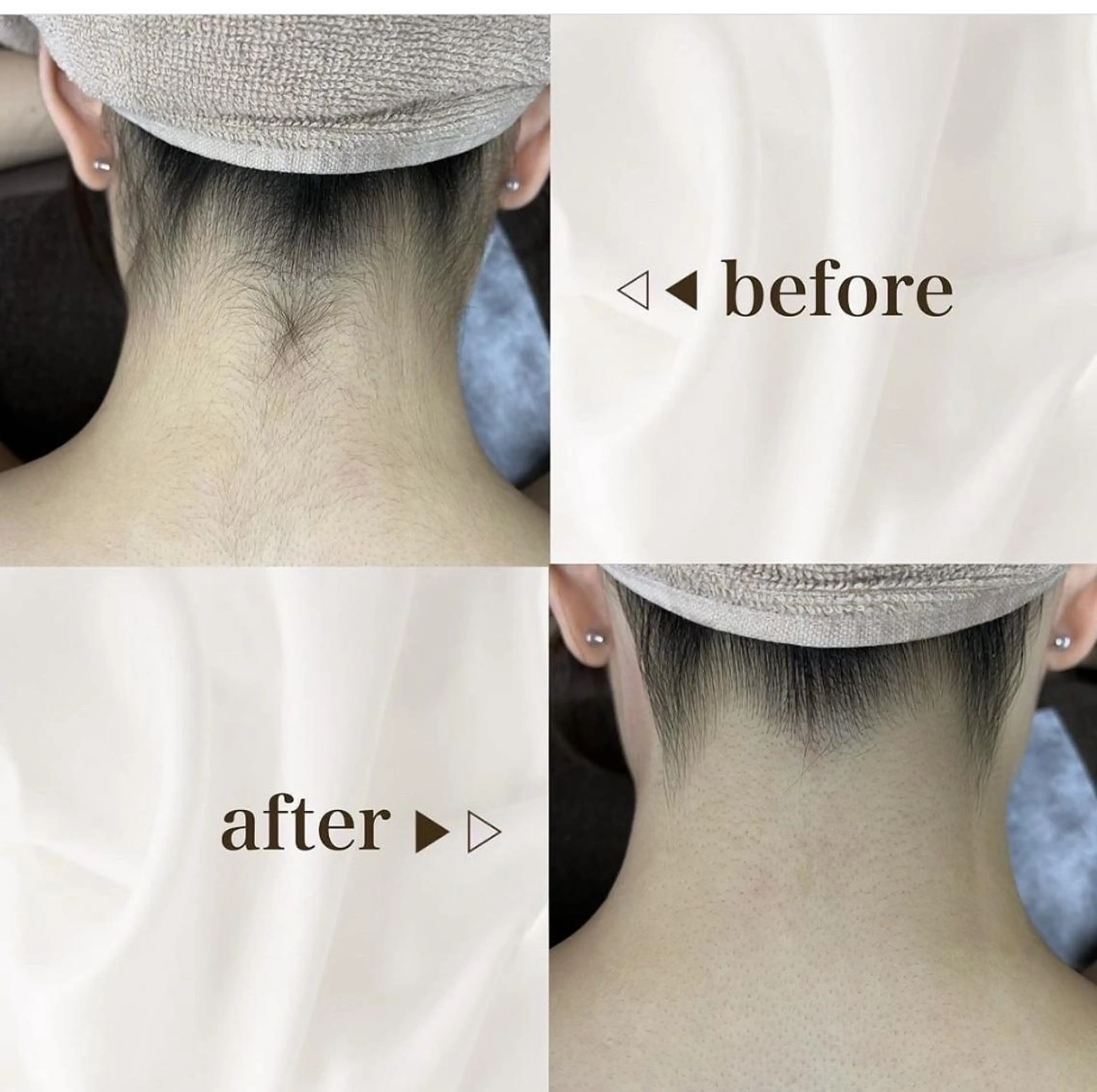 【ミニモ限定】大人気🔥うなじ脱毛シェービング付きの写真