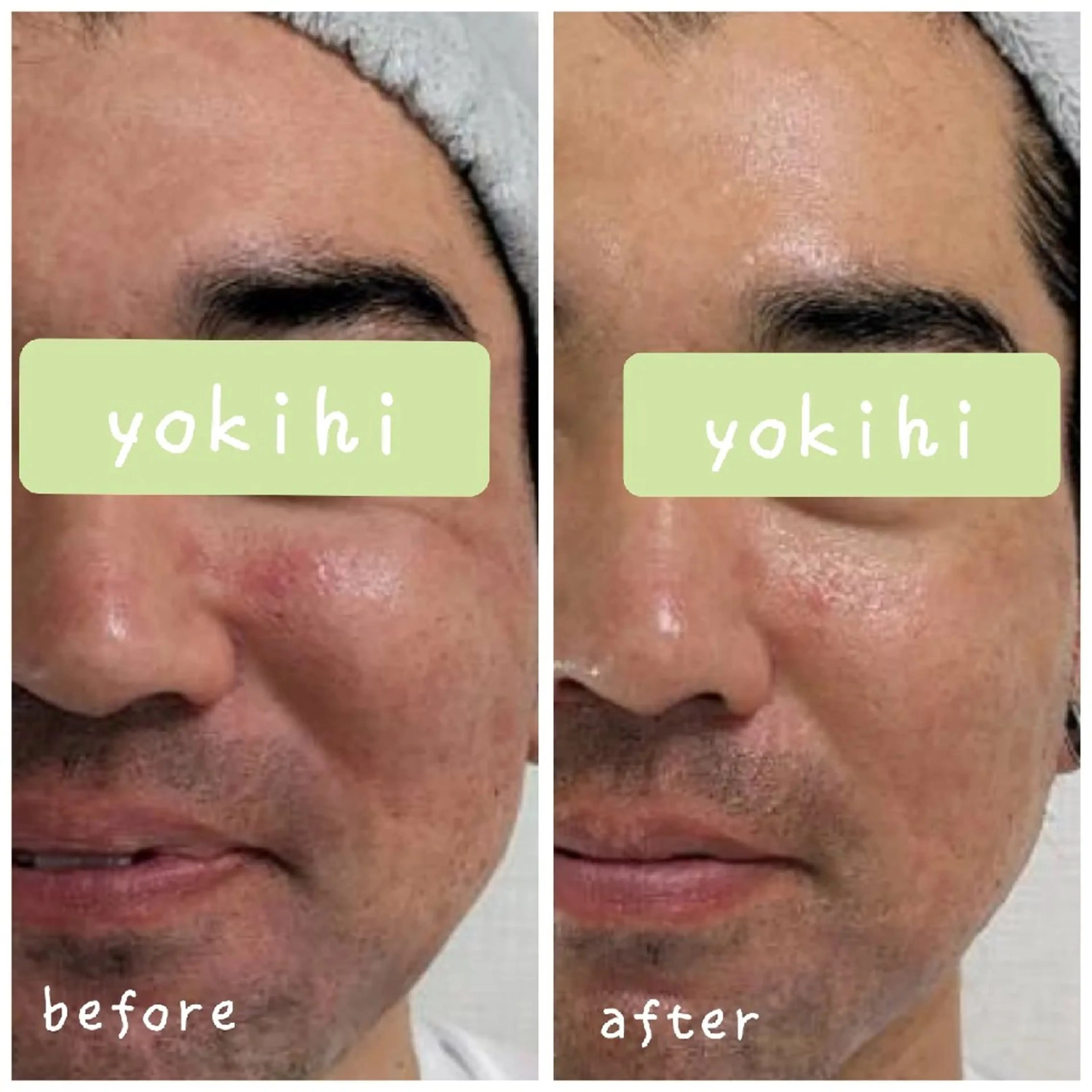 メンズ 結果が出るスキンケア 肌質改善/まつパのエステ・リラクイメージ