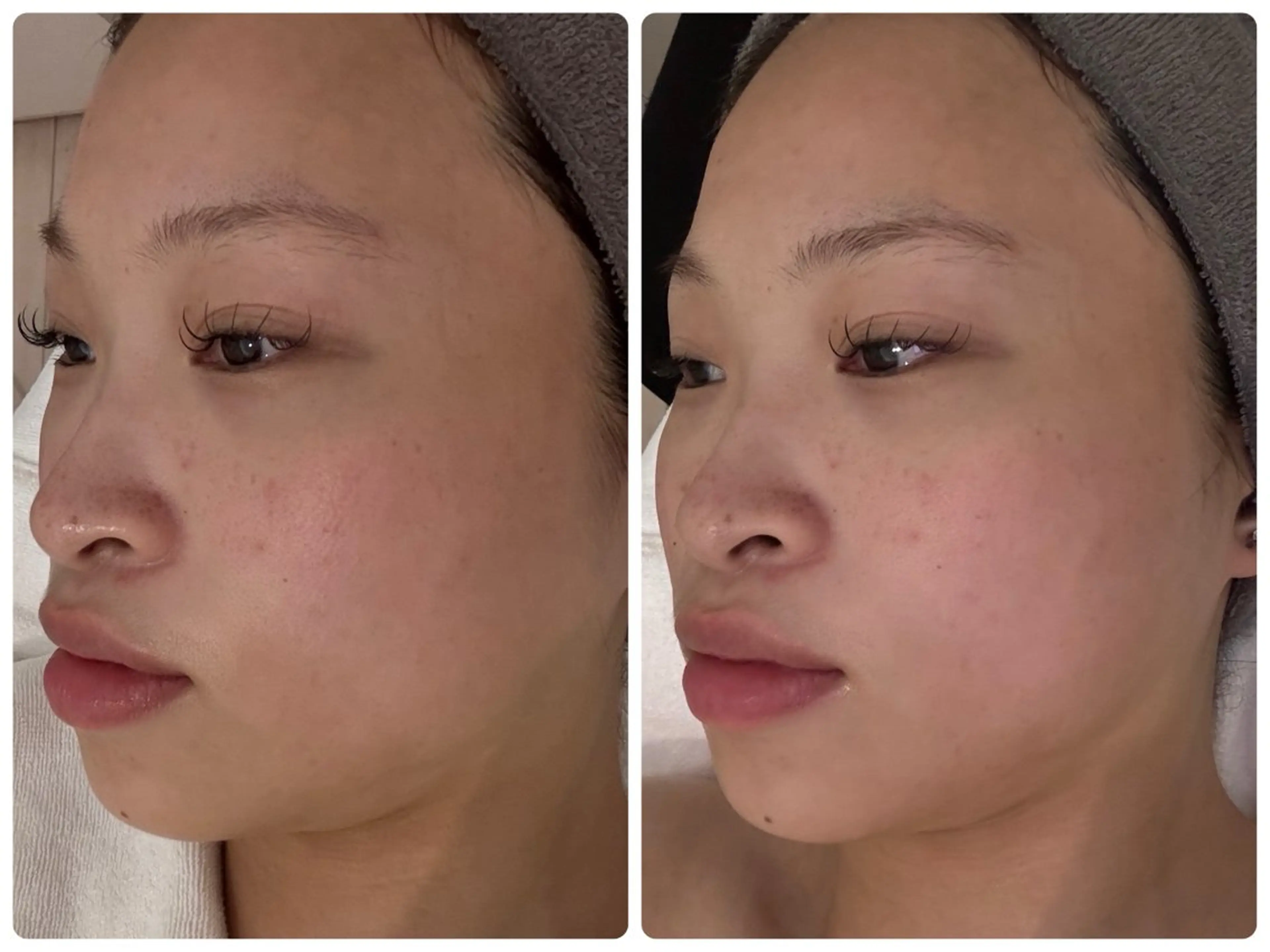 『ソフトピーリングケア』でくすみのない明るいお肌に🌟ゴワついた角層を優しく除去🫧フェイシャルエステ体験⭐️約45分の写真