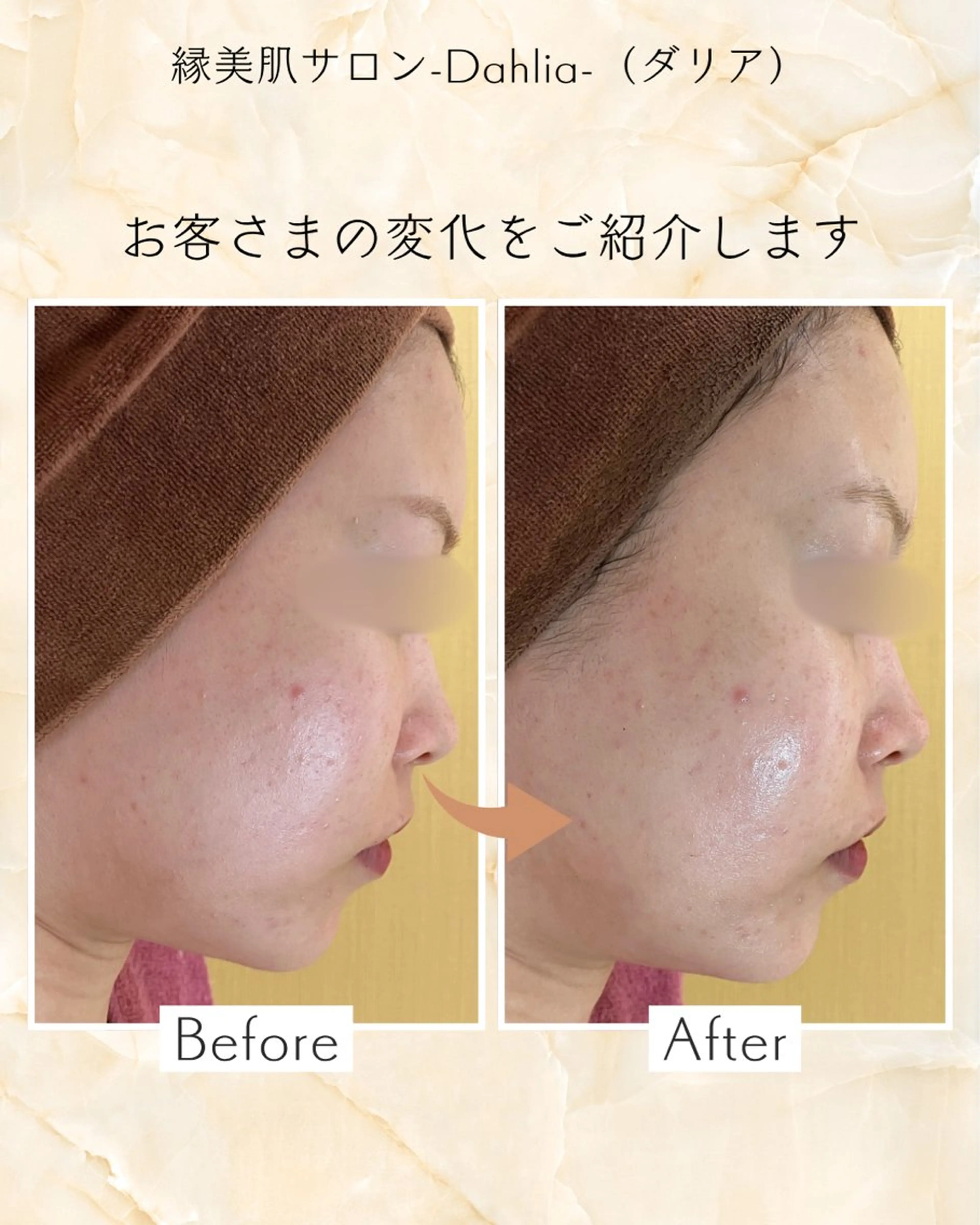 【くすみ集中ケア☆】ダウンタイムなしハーブピーリングで、1回でもわかる透明感♪つるんと素肌へ✨の写真