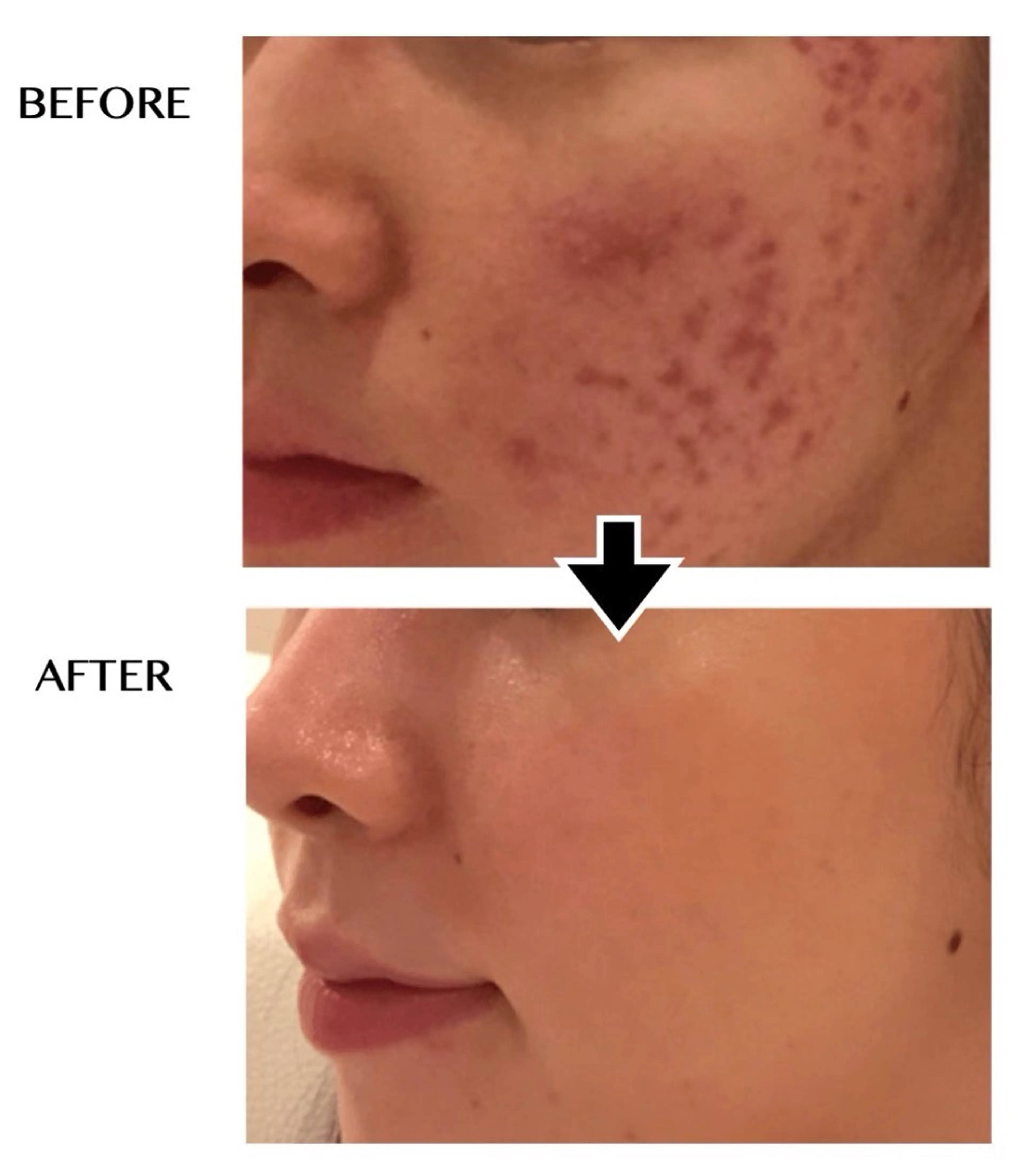 サーマナイフフェイシャル　超肌質改善の写真