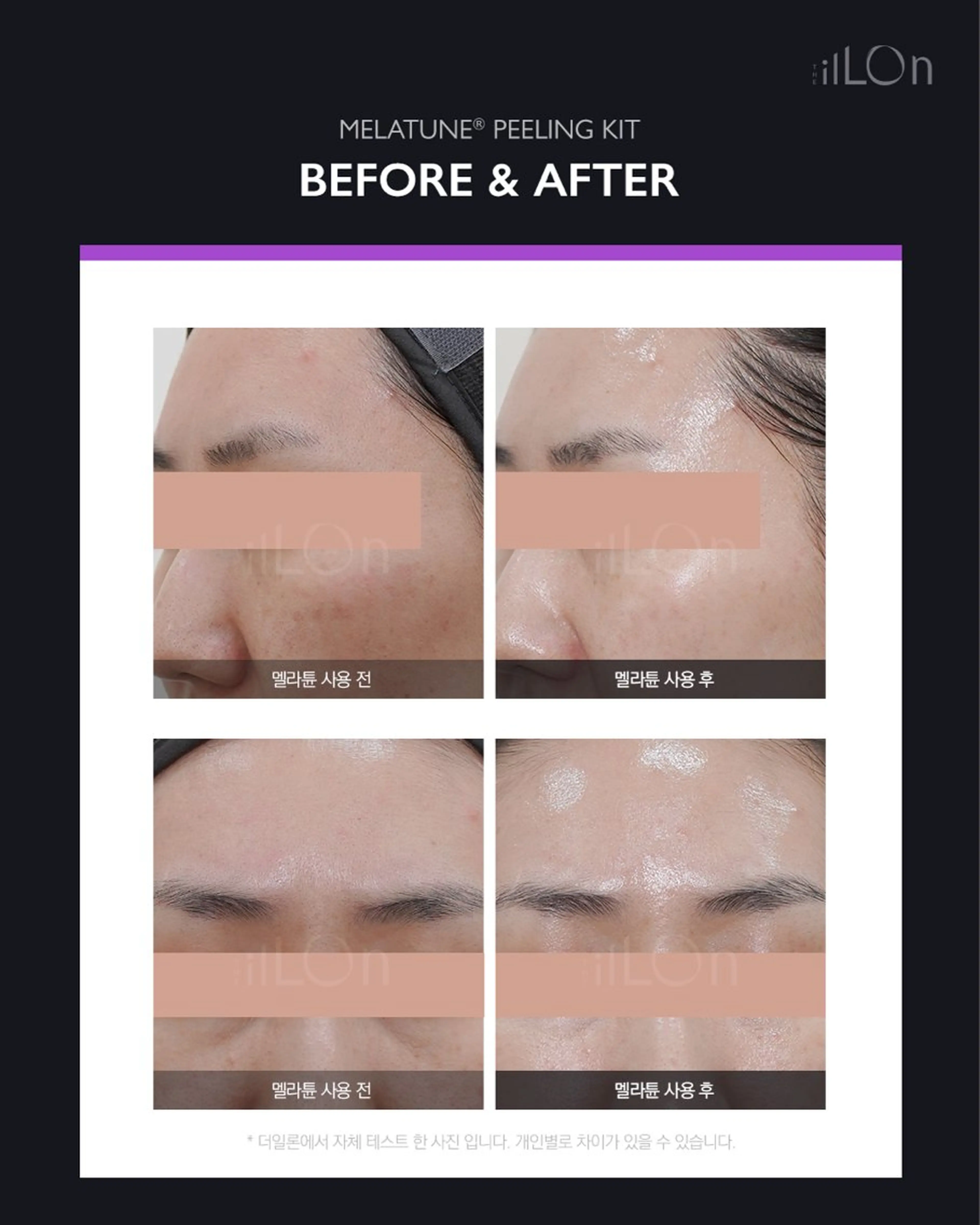 仮予約【3Dツヤ美白ピーリング🥚✨】今あるシミ、これからできるシミ予防に◎内側から発光するクリア肌へ🥚✨の写真