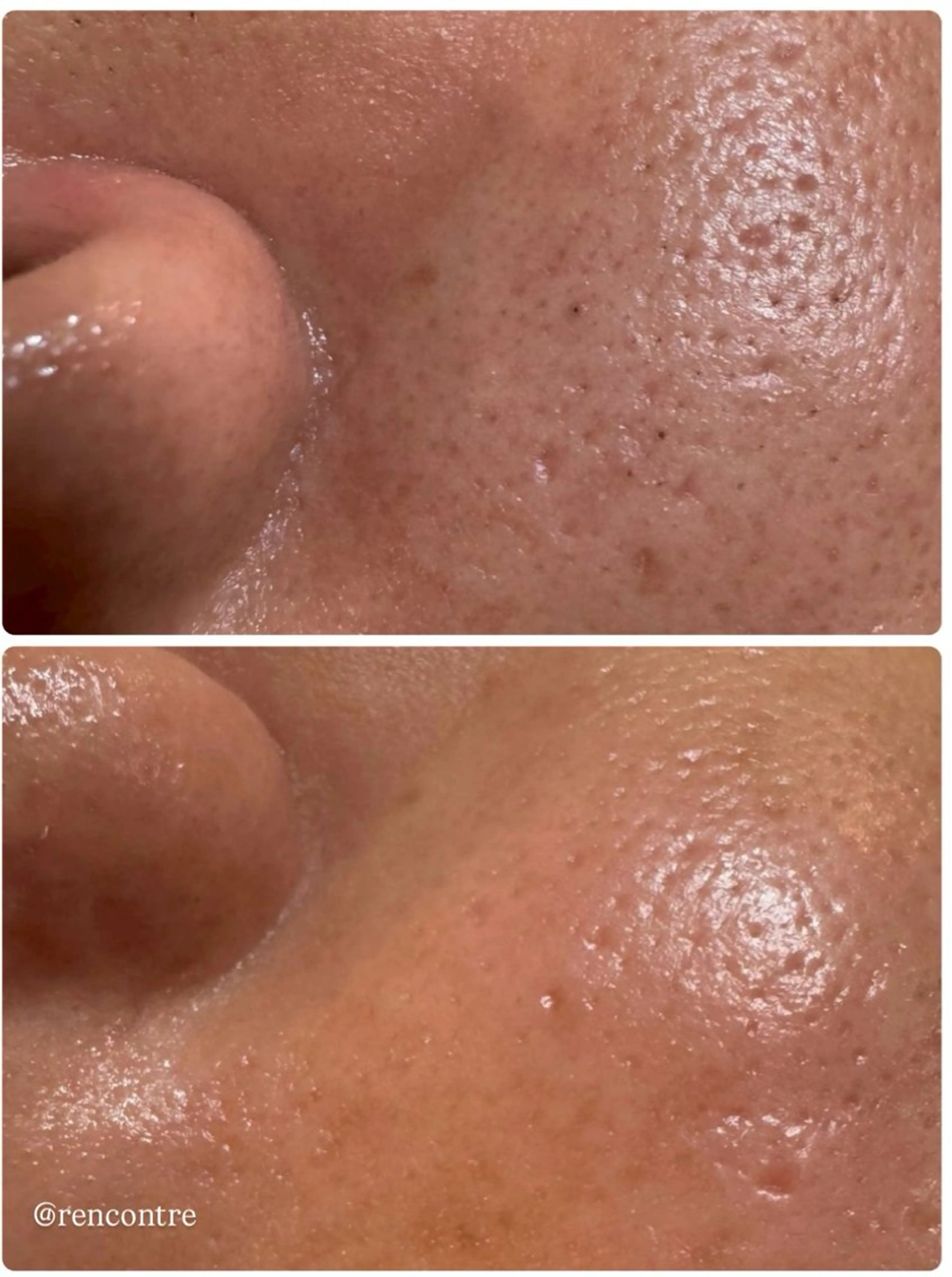 毛穴エクストラクションの写真