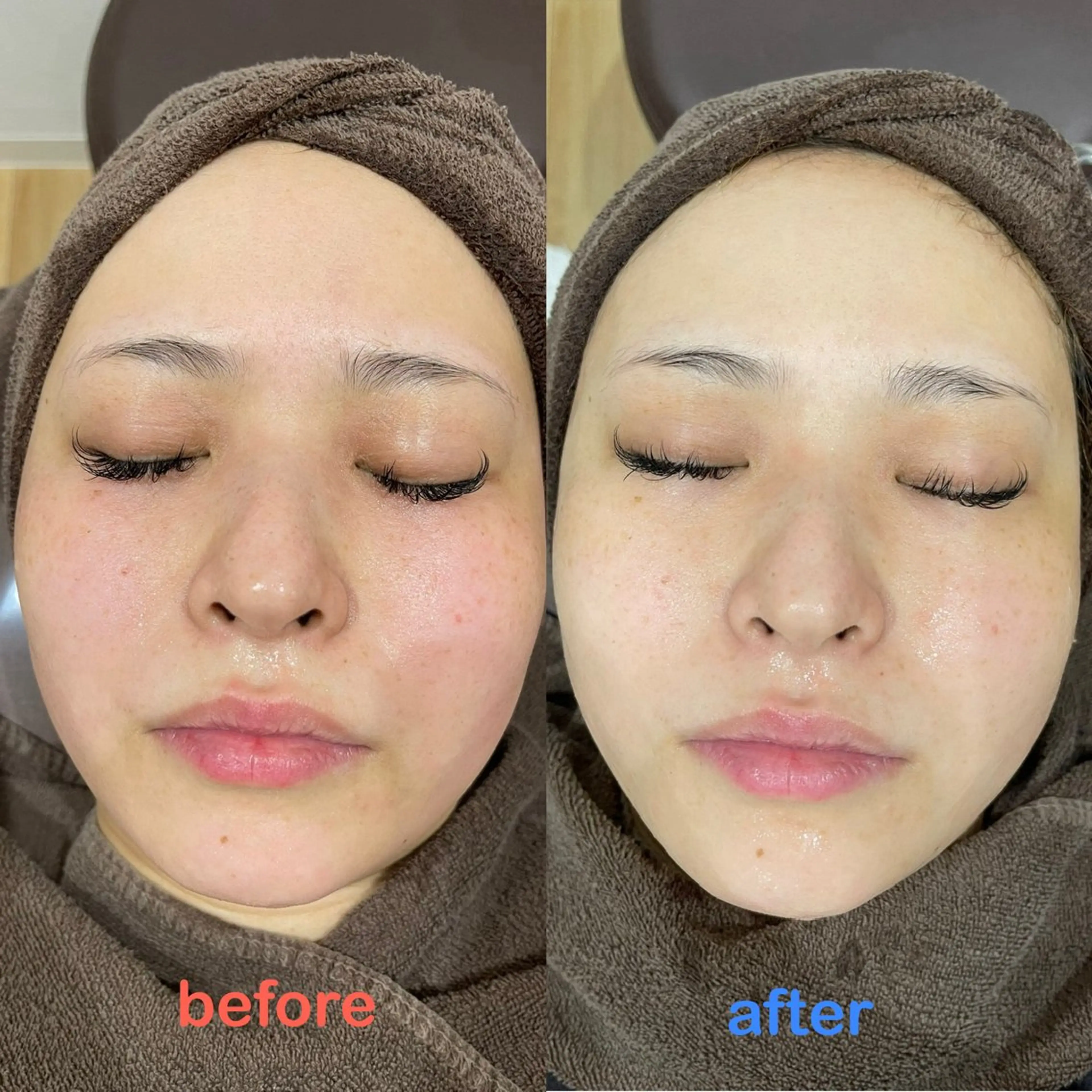 【初回体験】ツルもちお肌✨ハイドラフェイシャル&エレクトロポレーションの写真