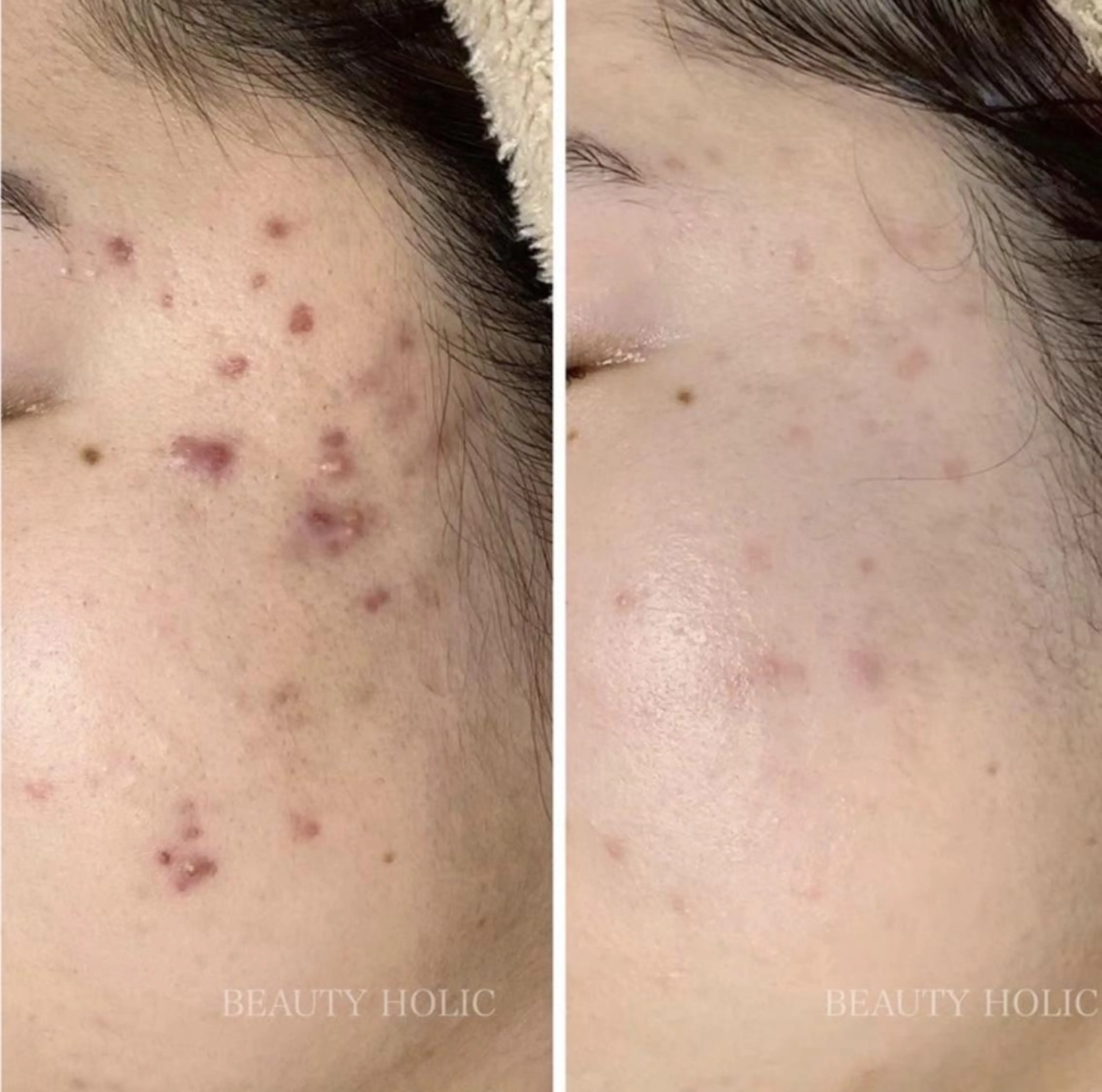 ニキビ・ 肌荒れ専門店のエステ・リラクイメージ