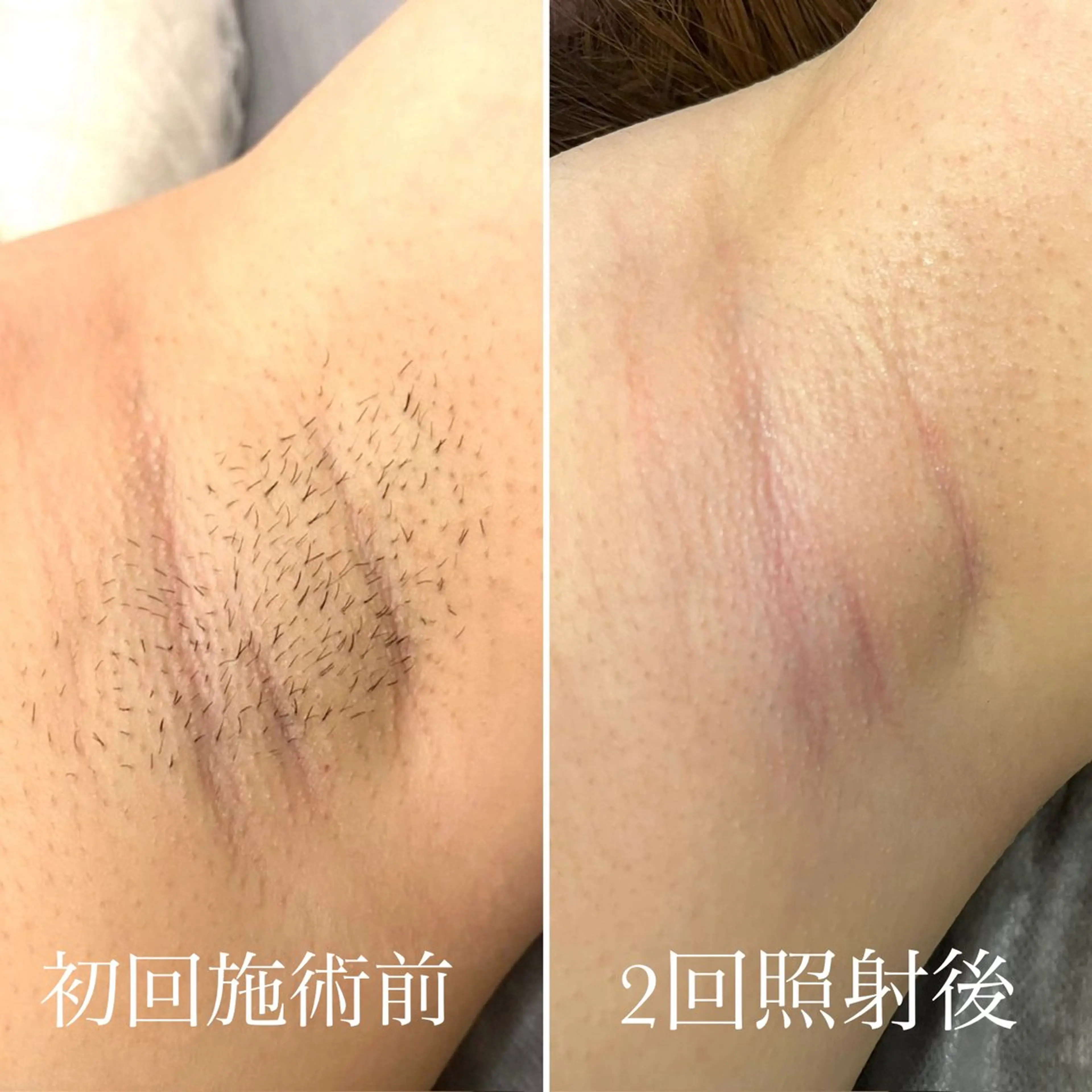 【再来予約専用】全身脱毛(顔・VIO込)の写真