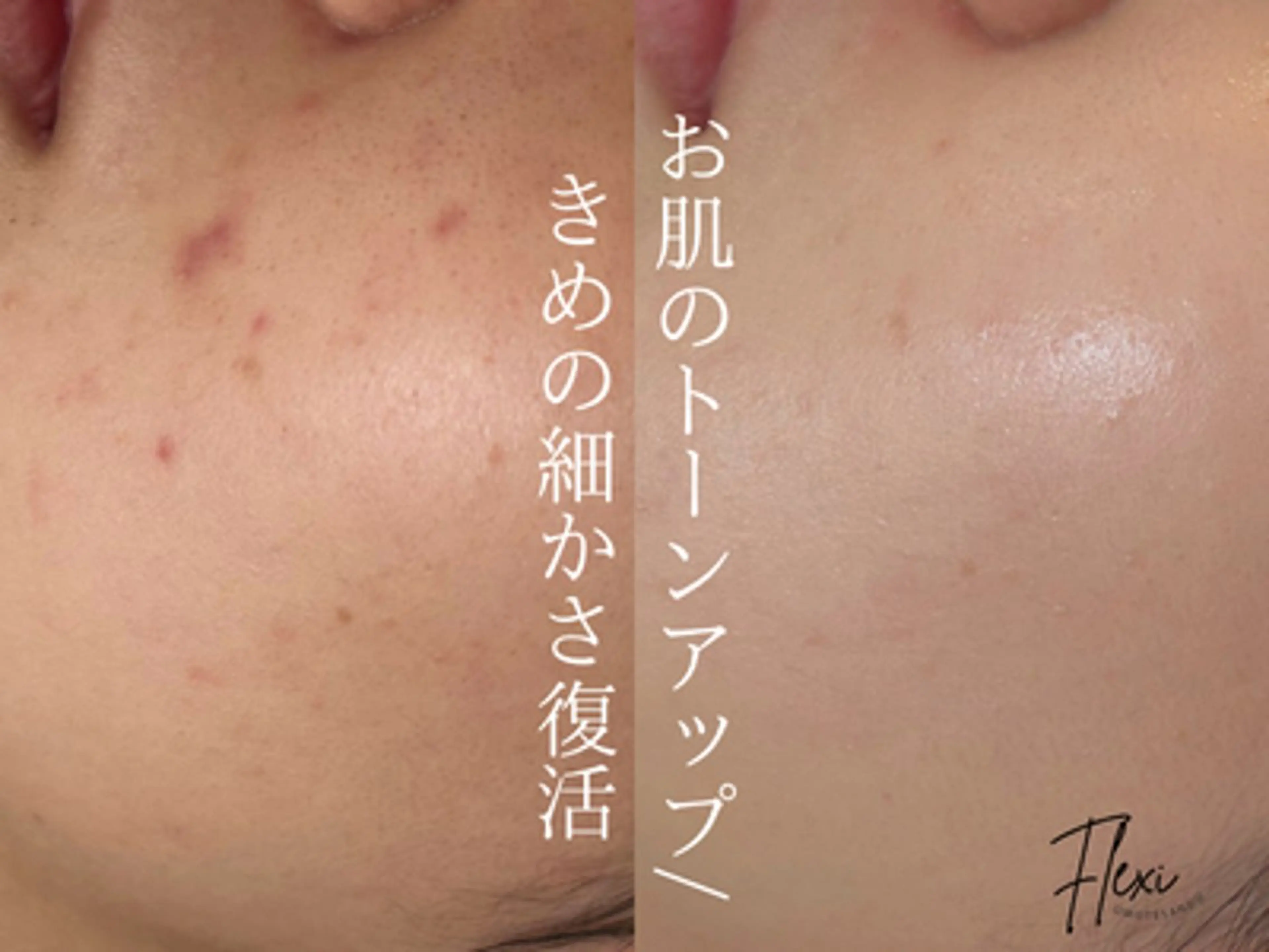 【カサカサ肌からツヤ肌へ】乾燥・肌荒れ改善ピーリングコースの写真