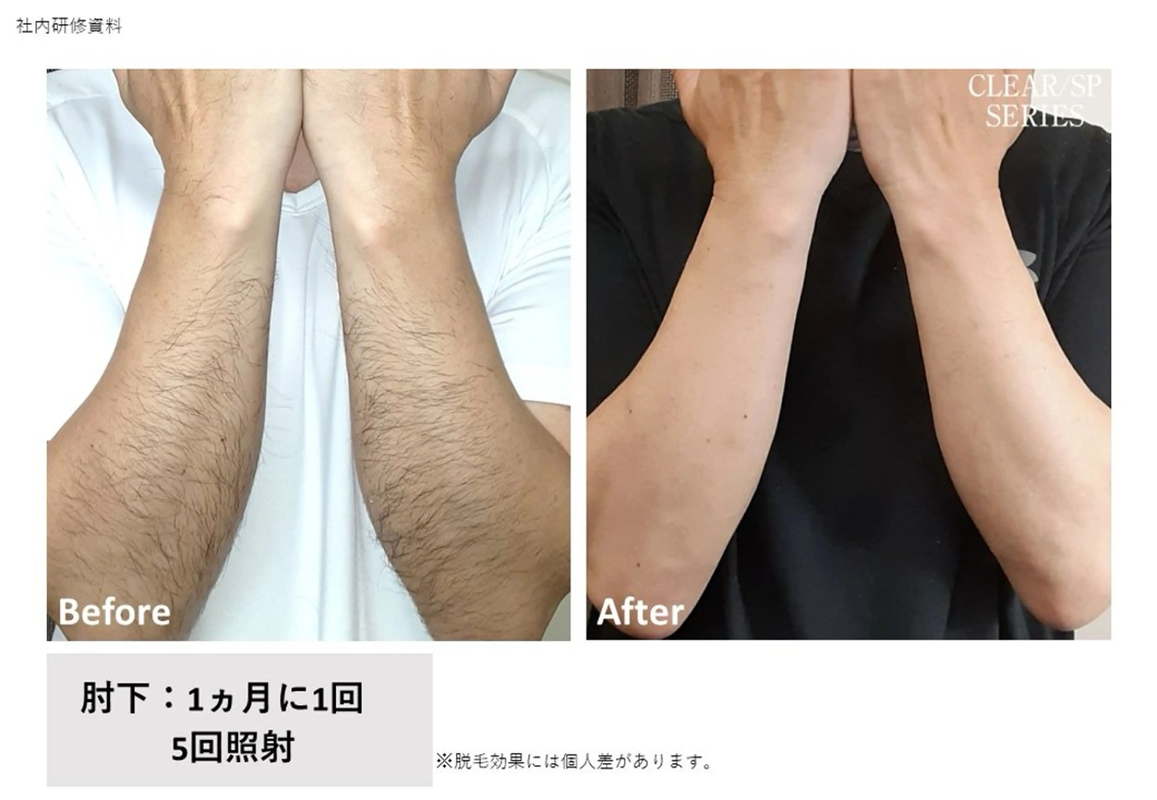 男性🫧腕脱毛の写真