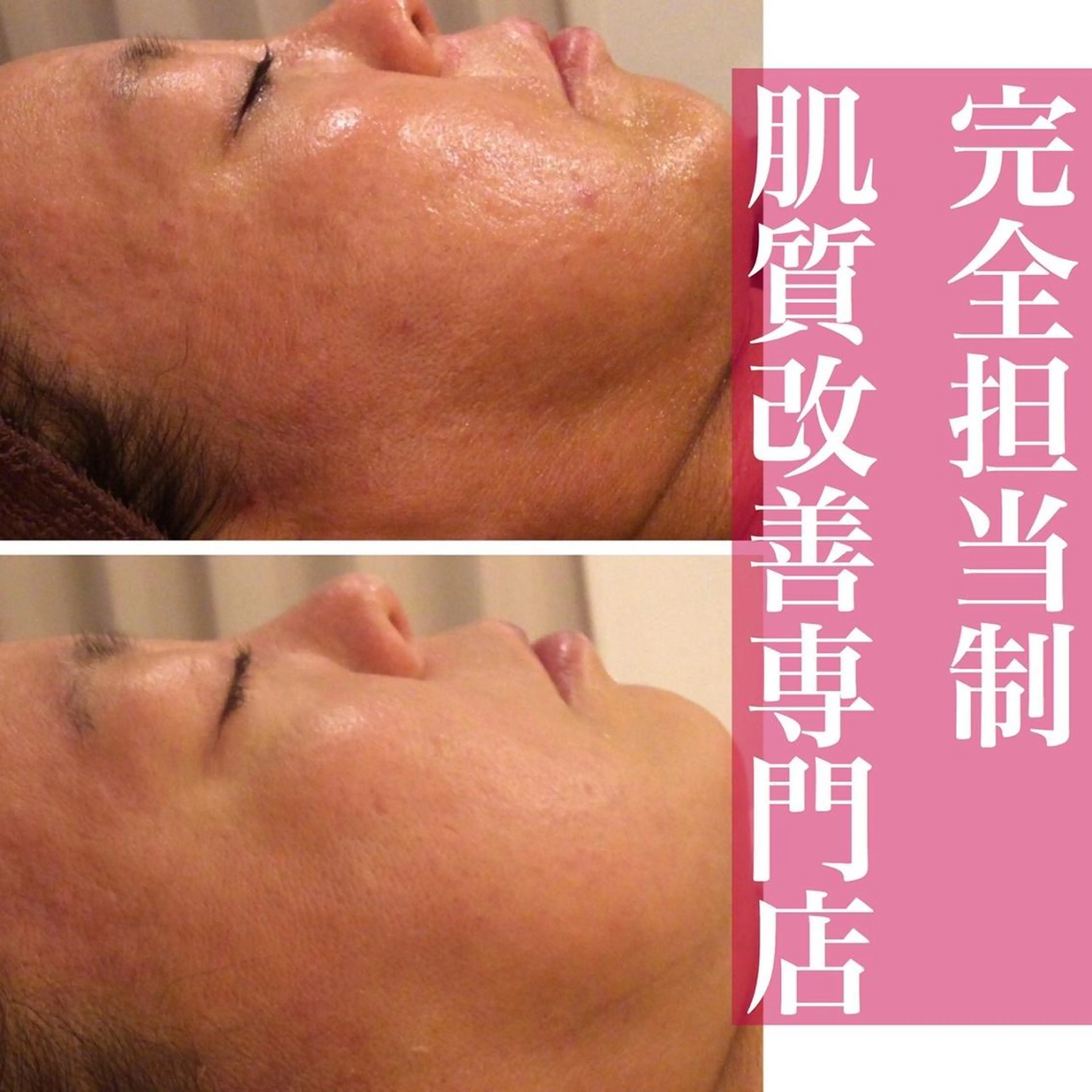 ニキビ特化型エステ 🍓最短で肌質改善のエステ・リラクイメージ