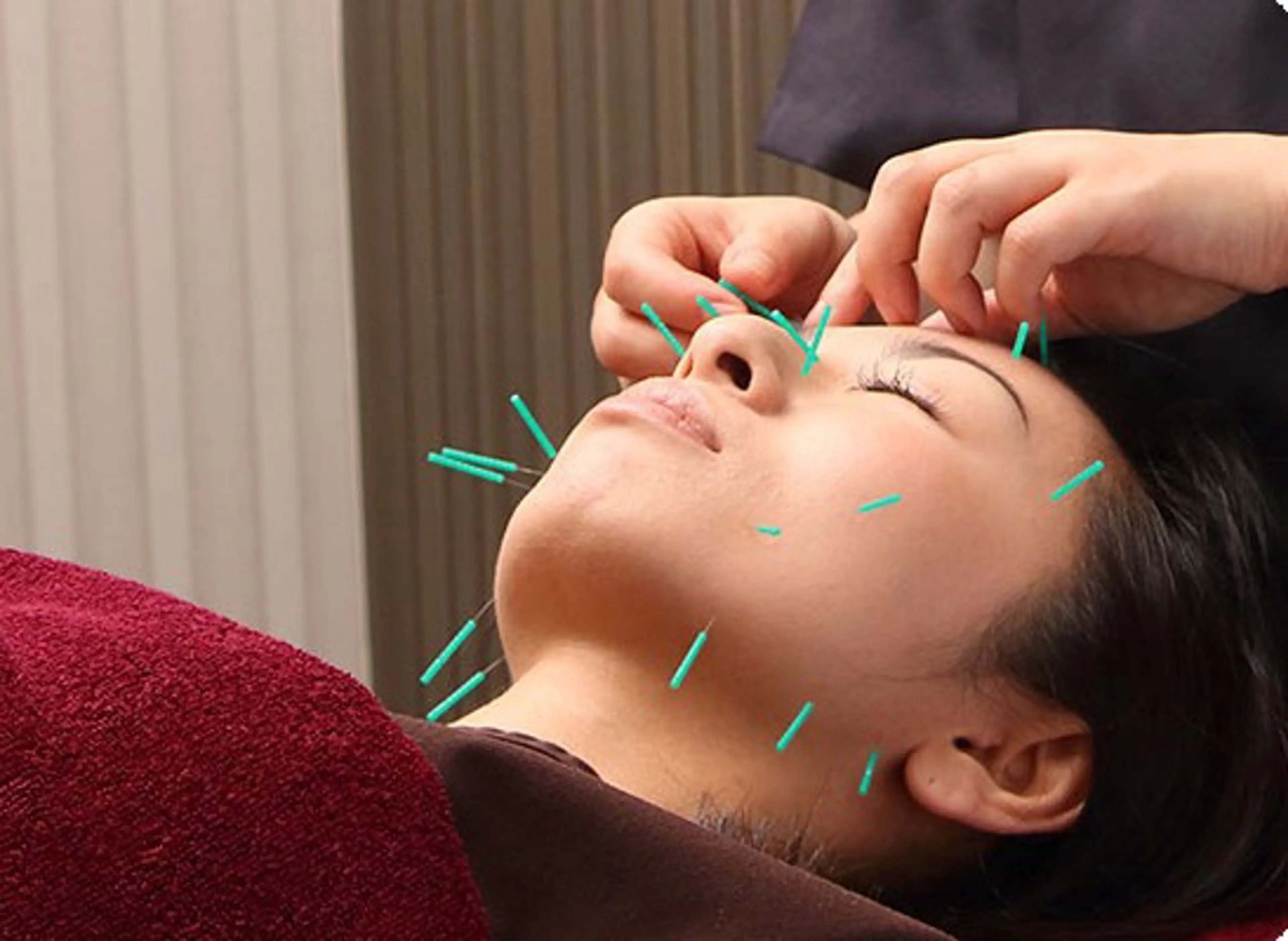 特別クーポン配布中 美容鍼・整体お得に!のその他イメージ