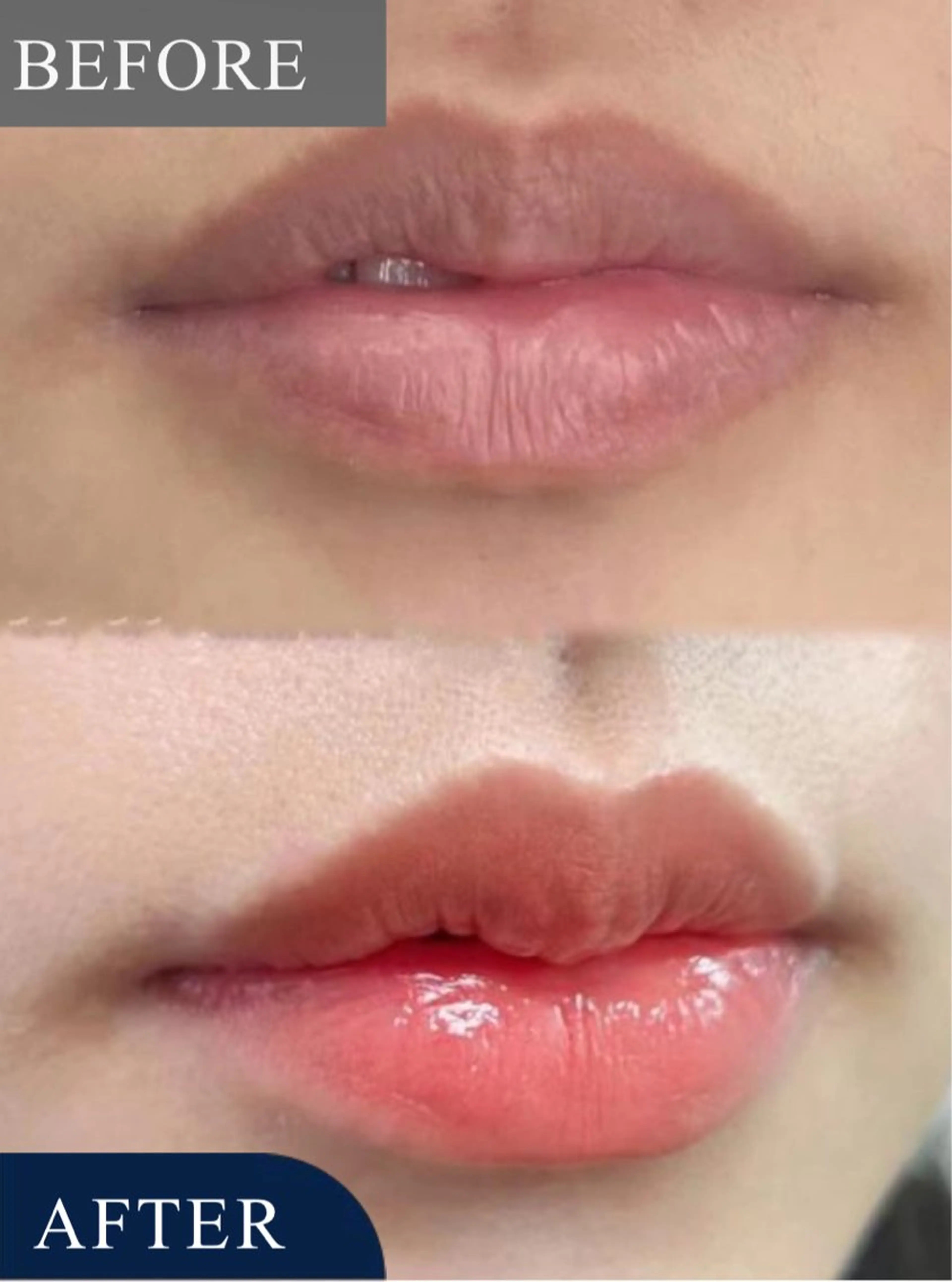 くちびるの色素沈着、色ムラ改善ケア！の写真