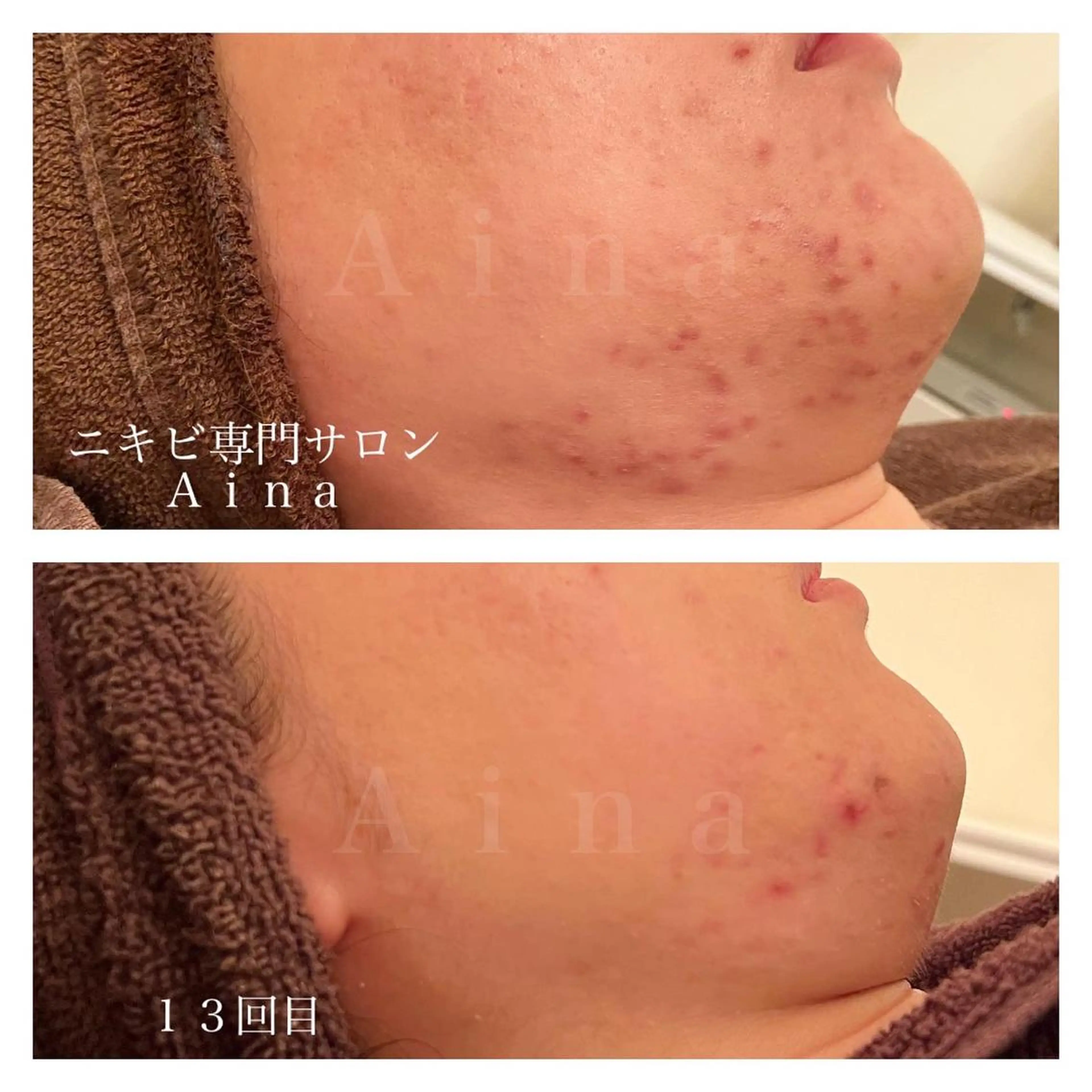 セミロング パーマ ヘアアレンジ メンズ キッズ ネイル マツエク・マツパ アイブロウ ニキビ跡専門サロン Ainaのエステ・リラクイメージ