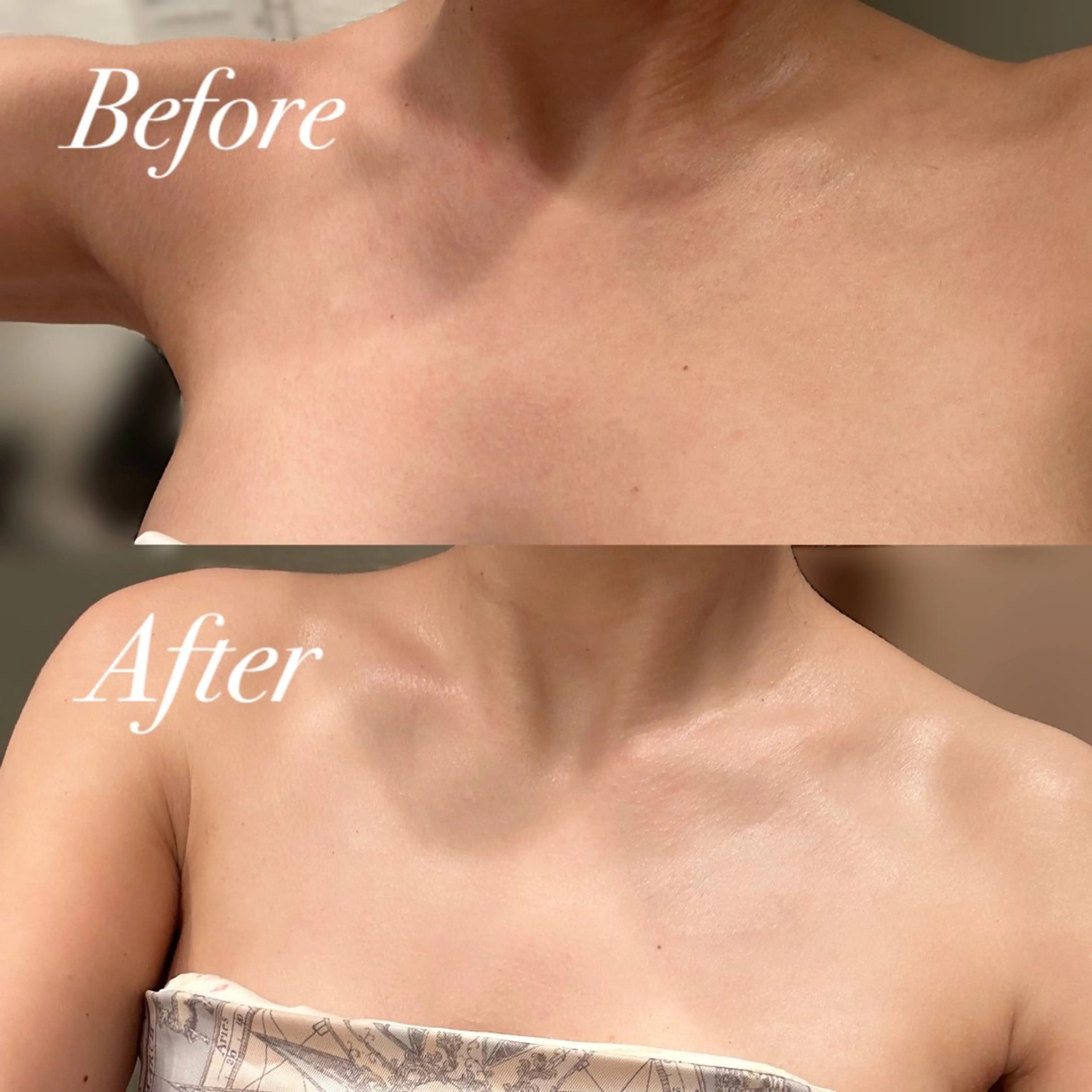 REVIハーブピーリング デコルテの写真